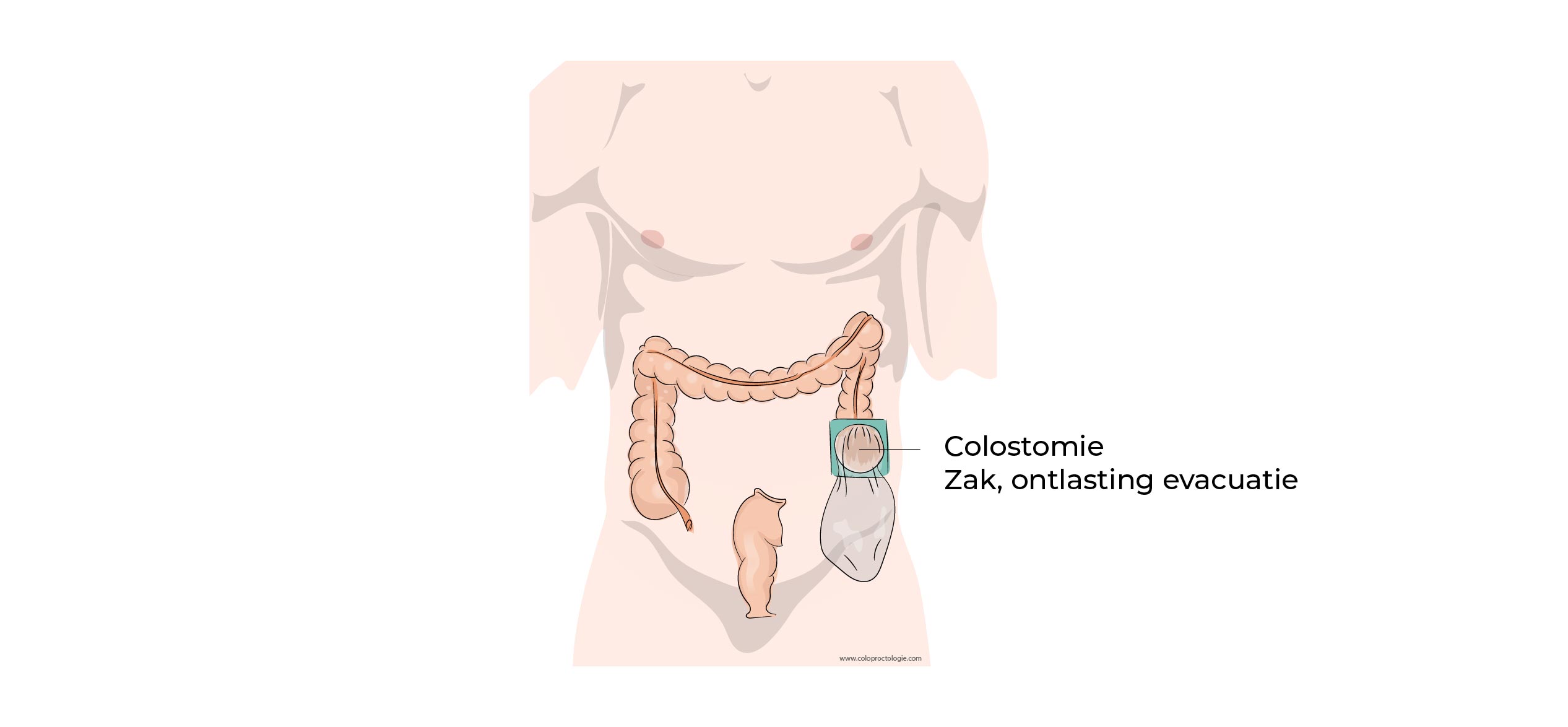 https://coloproctologie.com/wp-content/uploads/2023/07/Colectomie-droite-21.jpg