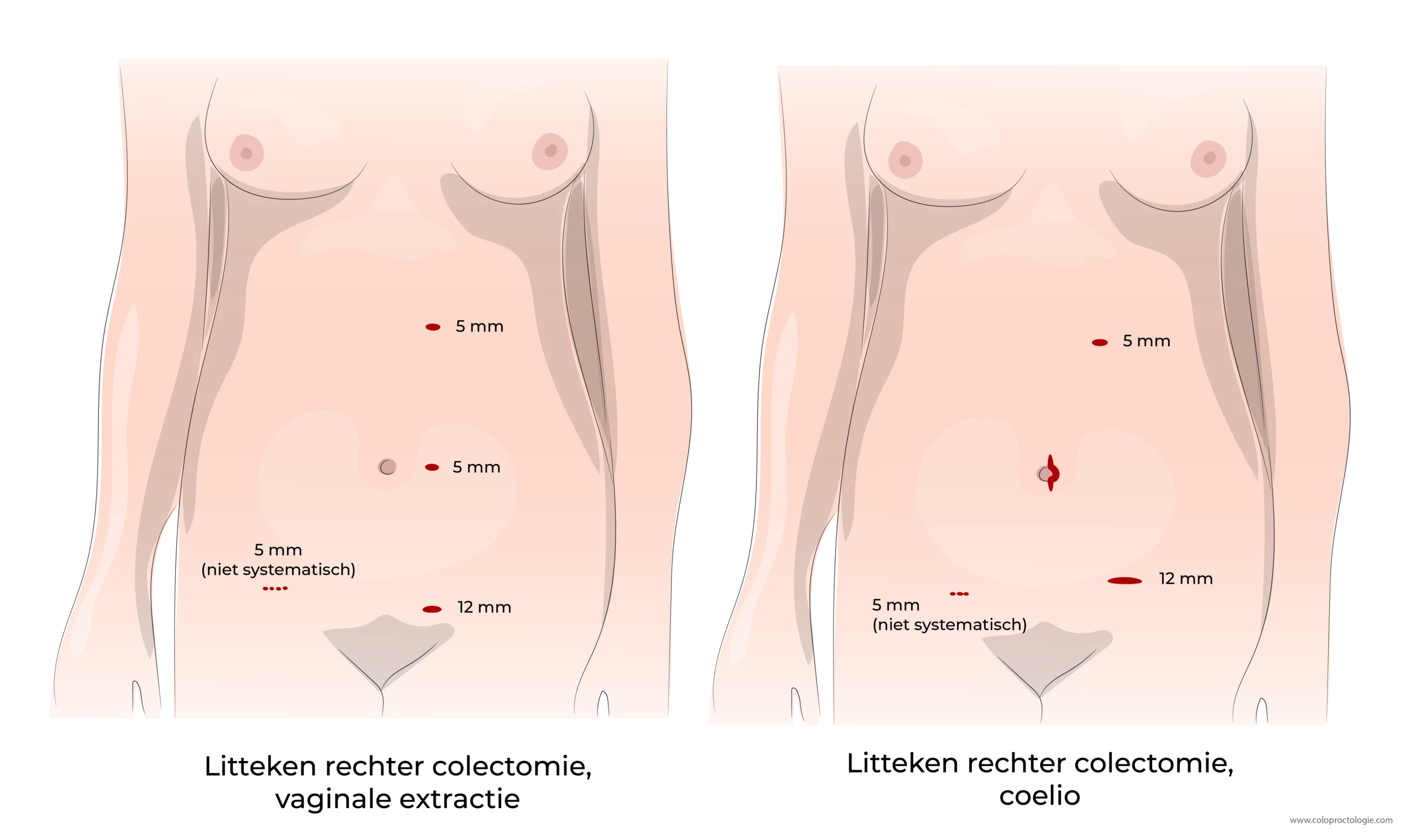 https://coloproctologie.com/wp-content/uploads/2023/07/Colectomie-droite-Litteken-rechter-colectomie-vaginale-extractie-18-V2-18-scaled.webp