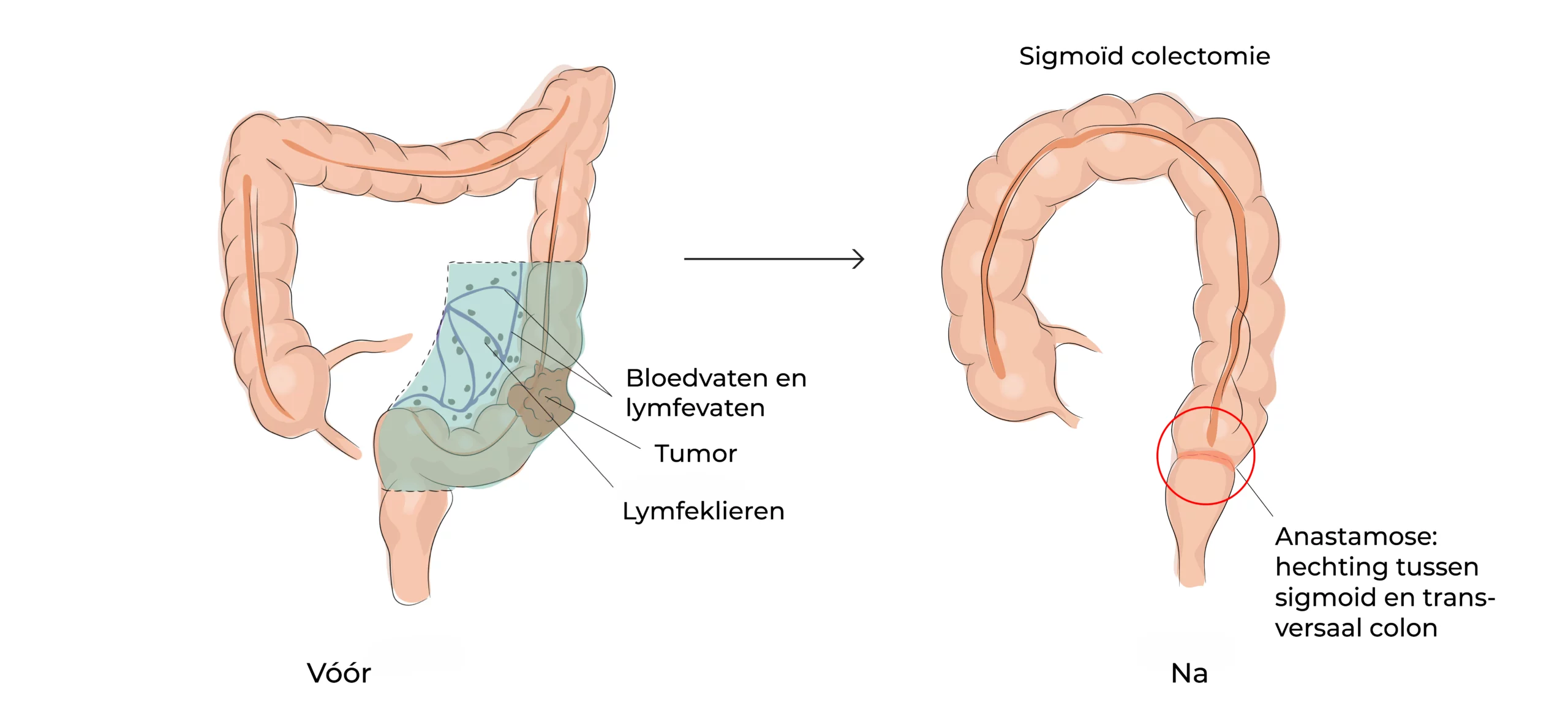 https://coloproctologie.com/wp-content/uploads/2023/07/Colectomie-gauche-Ndls-Step-1-08-scaled.webp