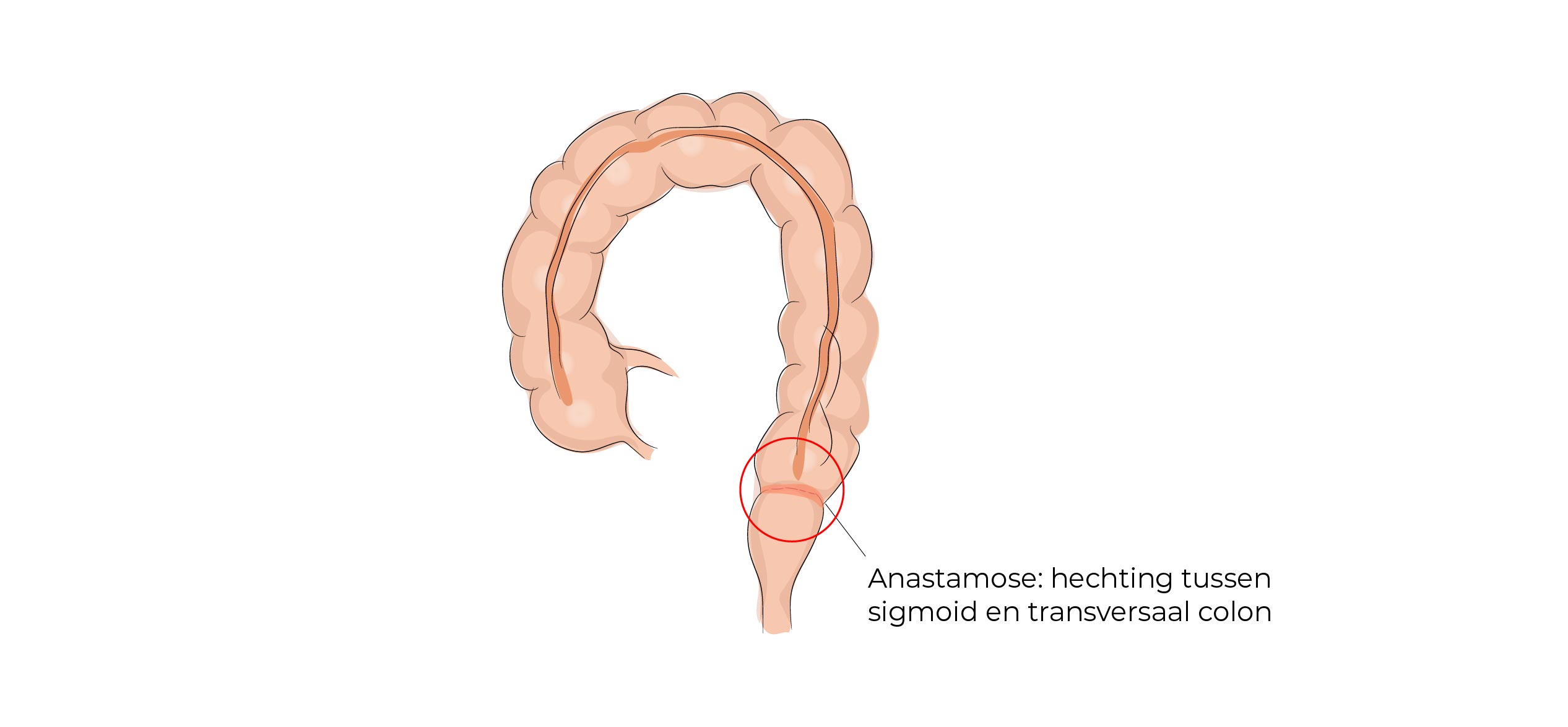 https://coloproctologie.com/wp-content/uploads/2023/07/Diverticulite-aigue-52.jpg