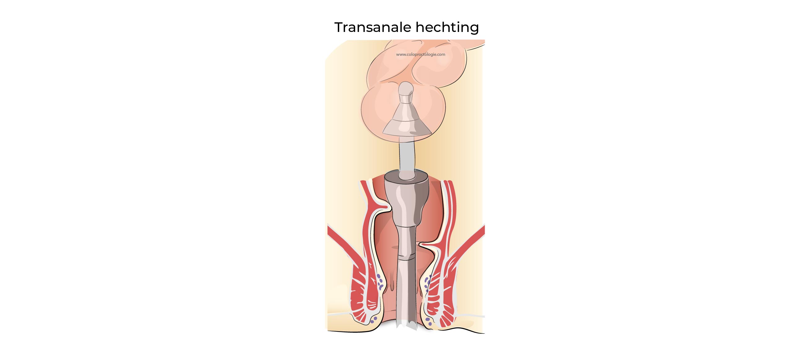 https://coloproctologie.com/wp-content/uploads/2023/07/Diverticulite-aigue-53.jpg