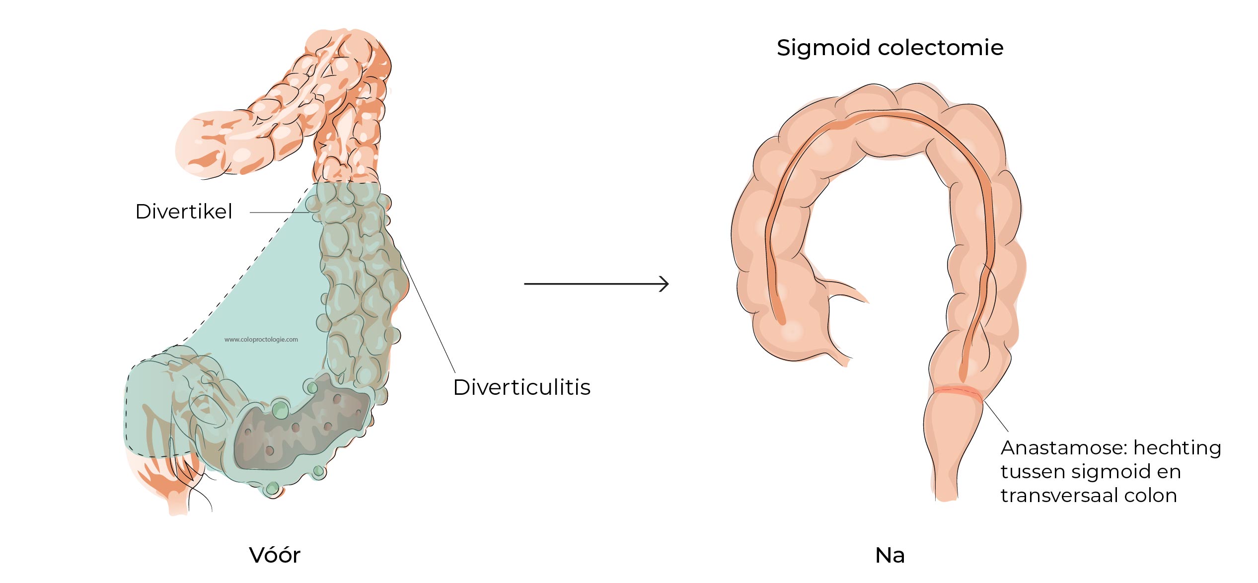 https://coloproctologie.com/wp-content/uploads/2023/07/Diverticulite-aigue-55.jpg