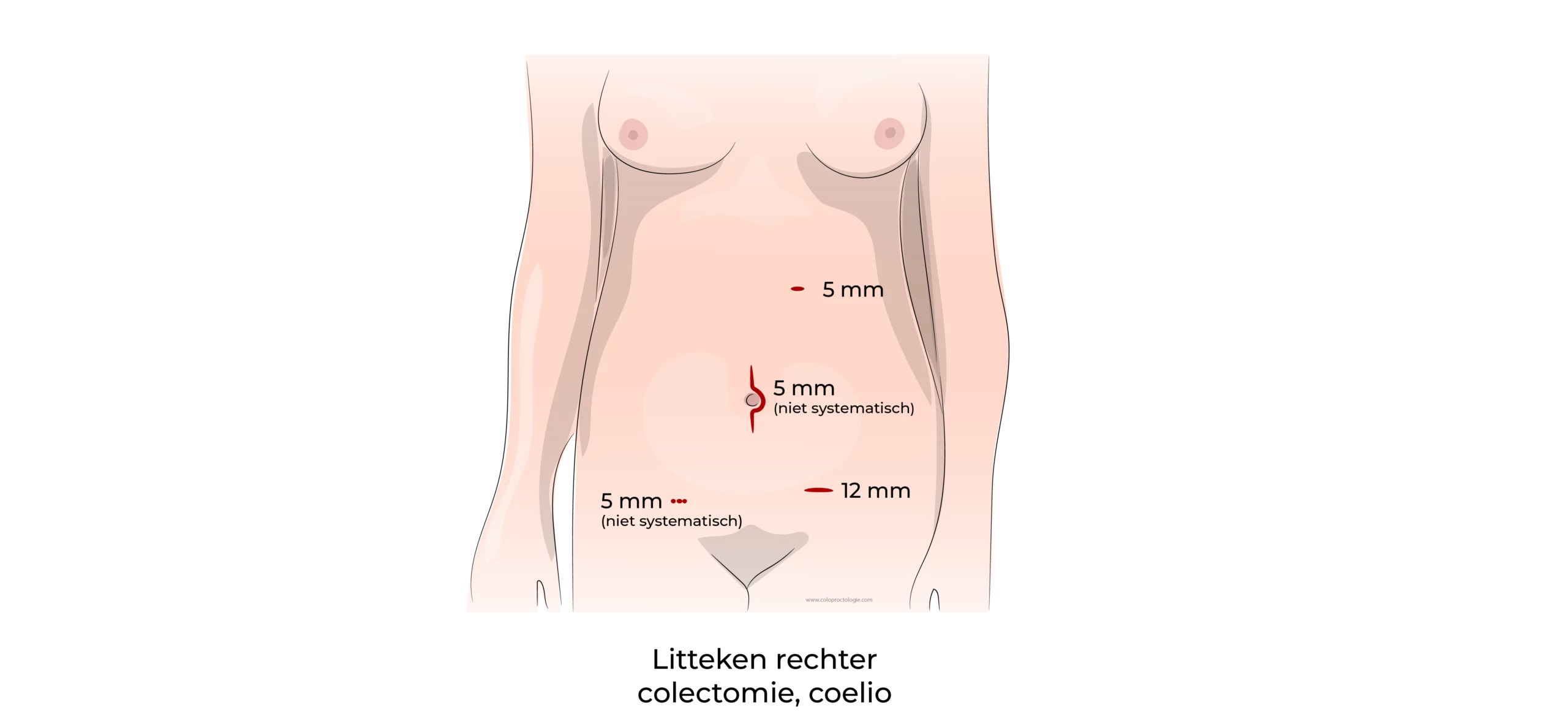 https://coloproctologie.com/wp-content/uploads/2023/07/Diverticulite-aigue-Ndls-Litteken-rechter-colectomie-coelio-54-54-scaled.webp