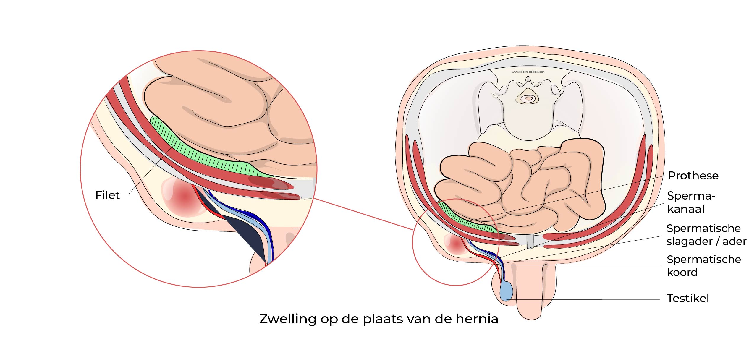 https://coloproctologie.com/wp-content/uploads/2023/07/Hernie-Inguinales-Illustrations-27.jpg