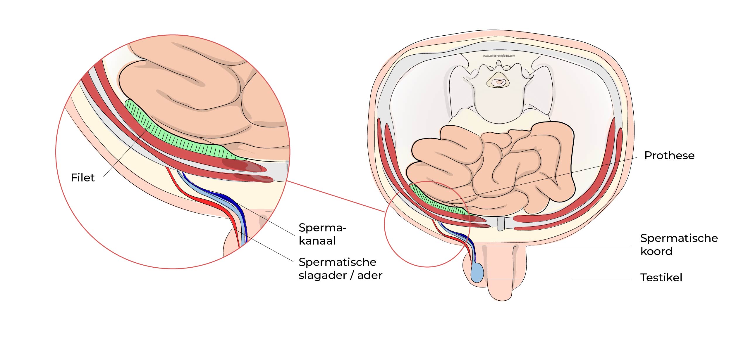 https://coloproctologie.com/wp-content/uploads/2023/07/Hernie-Inguinales-Illustrations-28.jpg