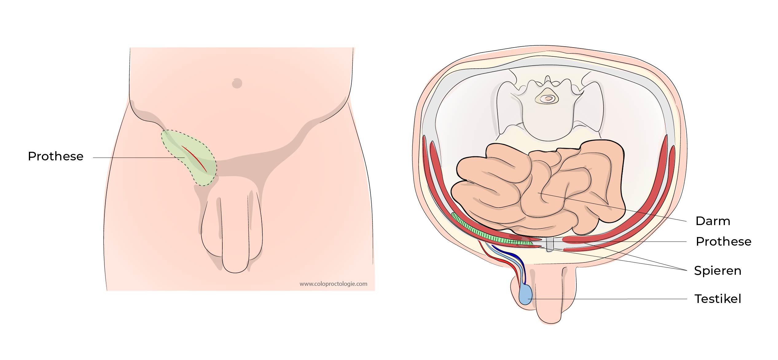 https://coloproctologie.com/wp-content/uploads/2023/07/Hernie-Inguinales-Illustrations-33.jpg