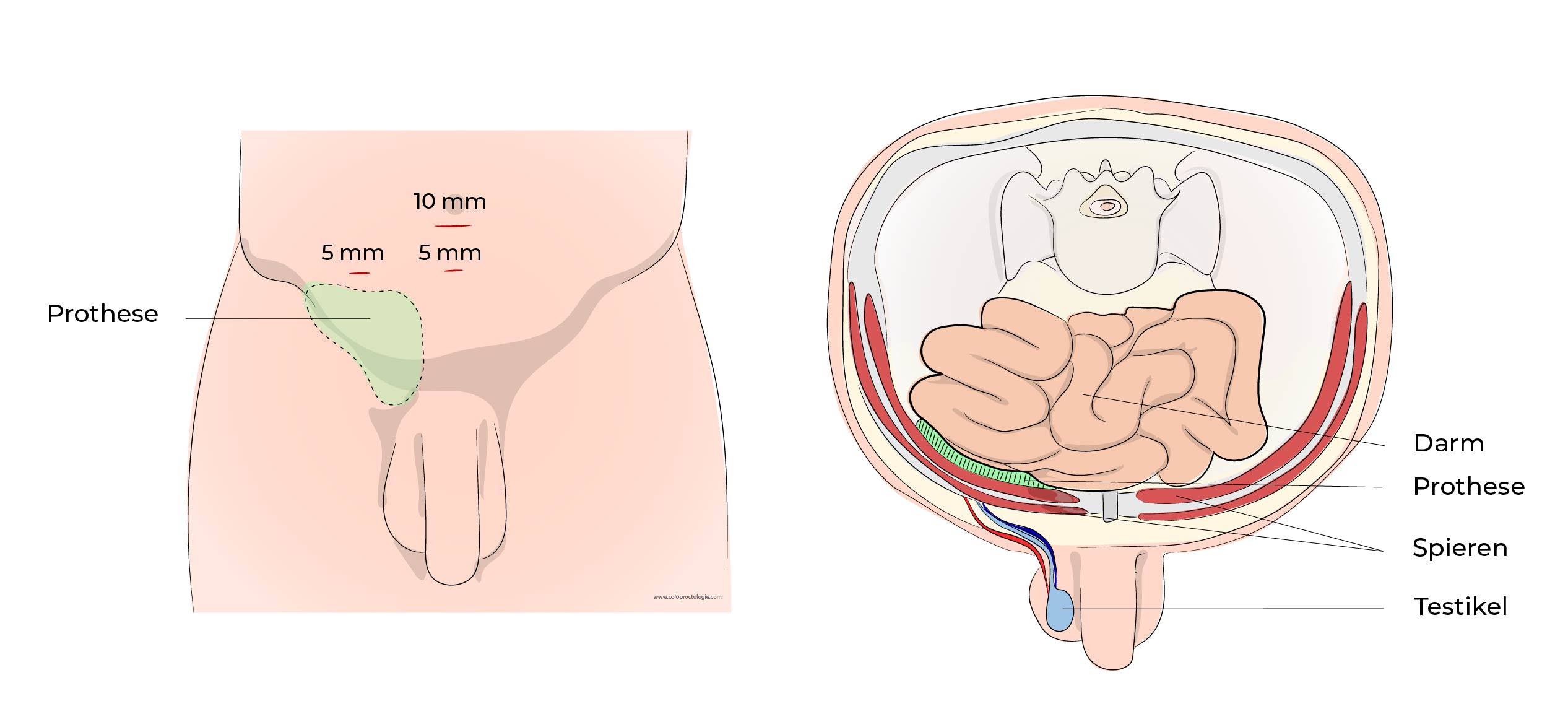 https://coloproctologie.com/wp-content/uploads/2023/07/Hernie-Inguinales-Illustrations-34.jpg