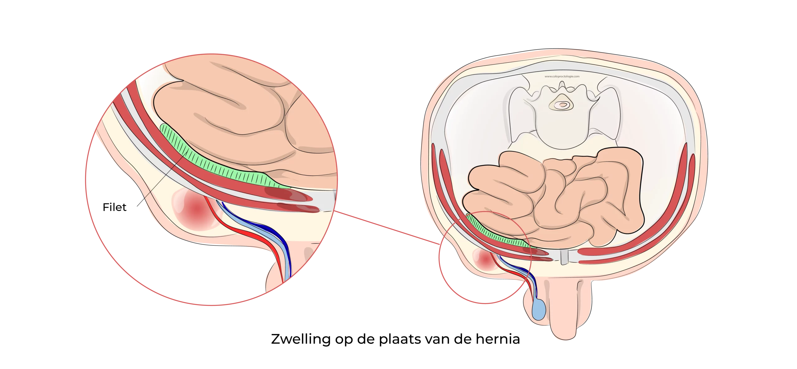 https://coloproctologie.com/wp-content/uploads/2023/07/Hernie-Inguinales-Illustrations-ndls-29-scaled.webp