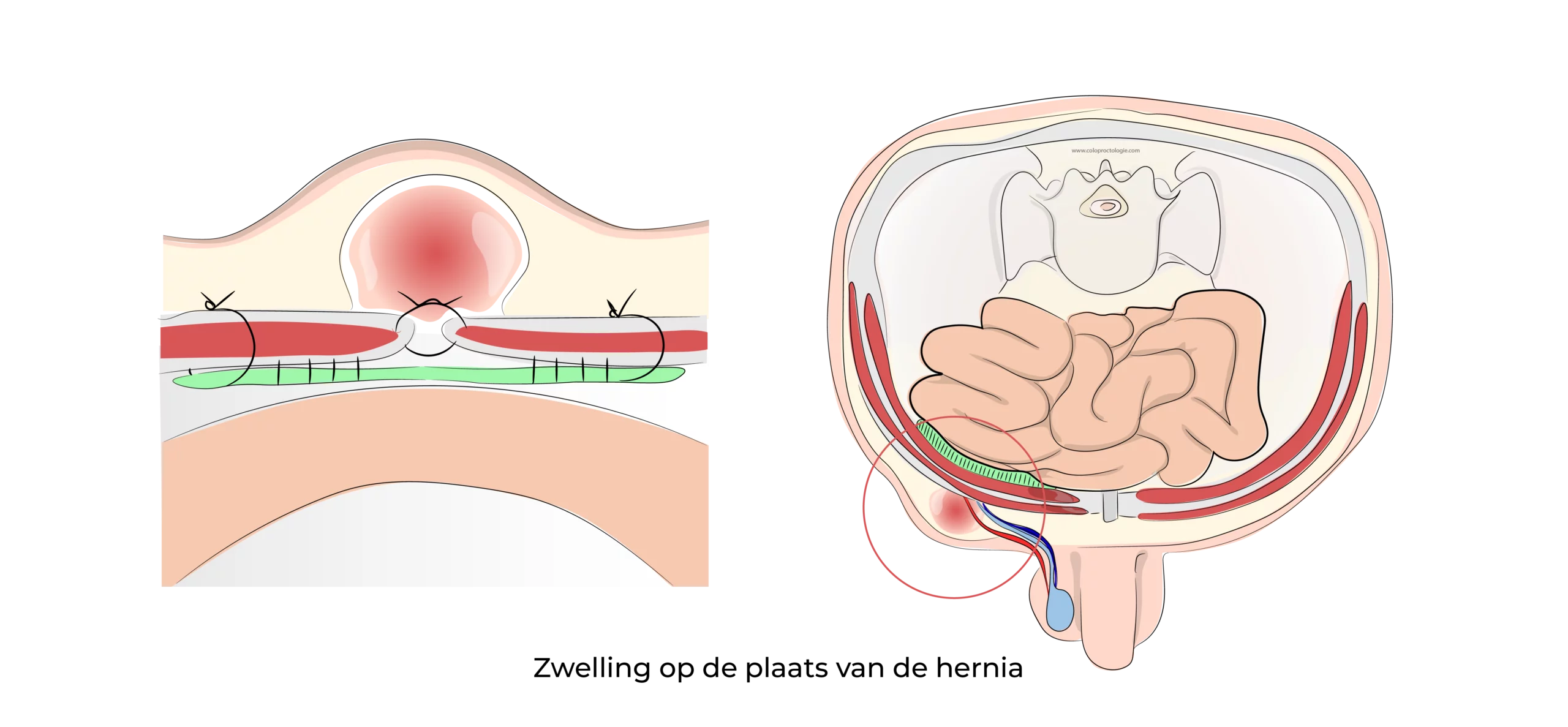 https://coloproctologie.com/wp-content/uploads/2023/07/Hernie-Inguinales-Illustrations-ndls-30-scaled.webp