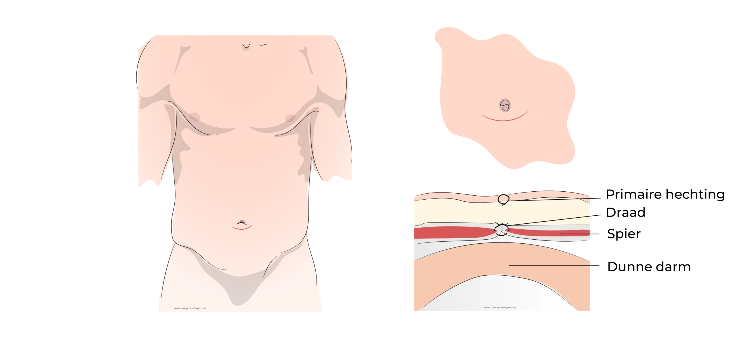 https://coloproctologie.com/wp-content/uploads/2023/07/Hernie-Ombilicale-Illustrations-34-34-scaled.webp