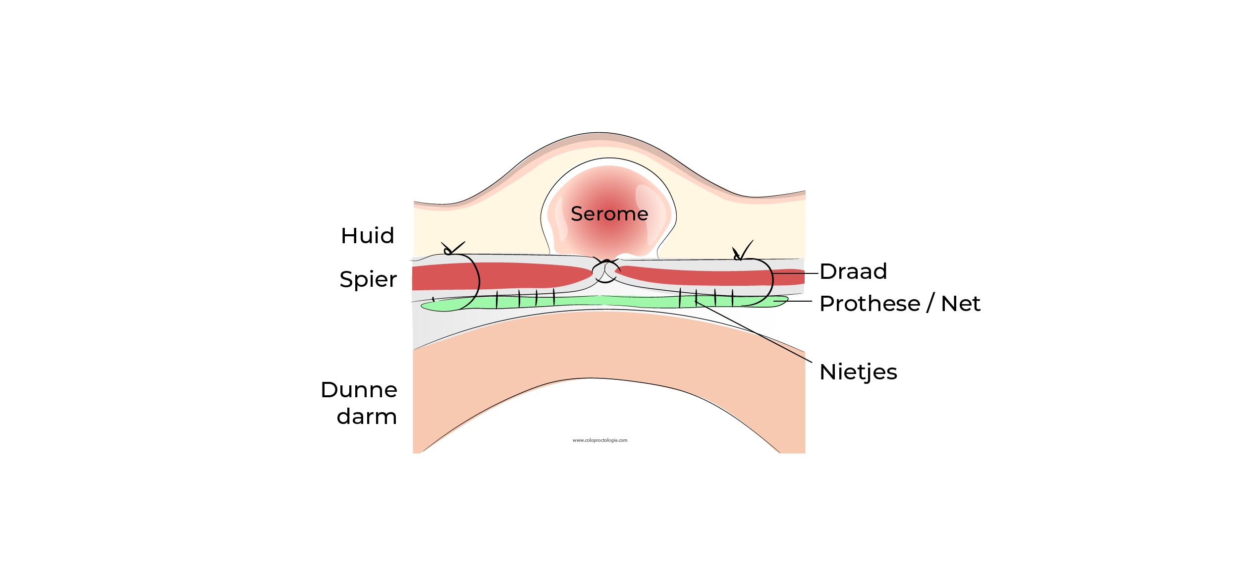 https://coloproctologie.com/wp-content/uploads/2023/07/Hernie-Ombilicale-Illustrations-Dutch-35.webp