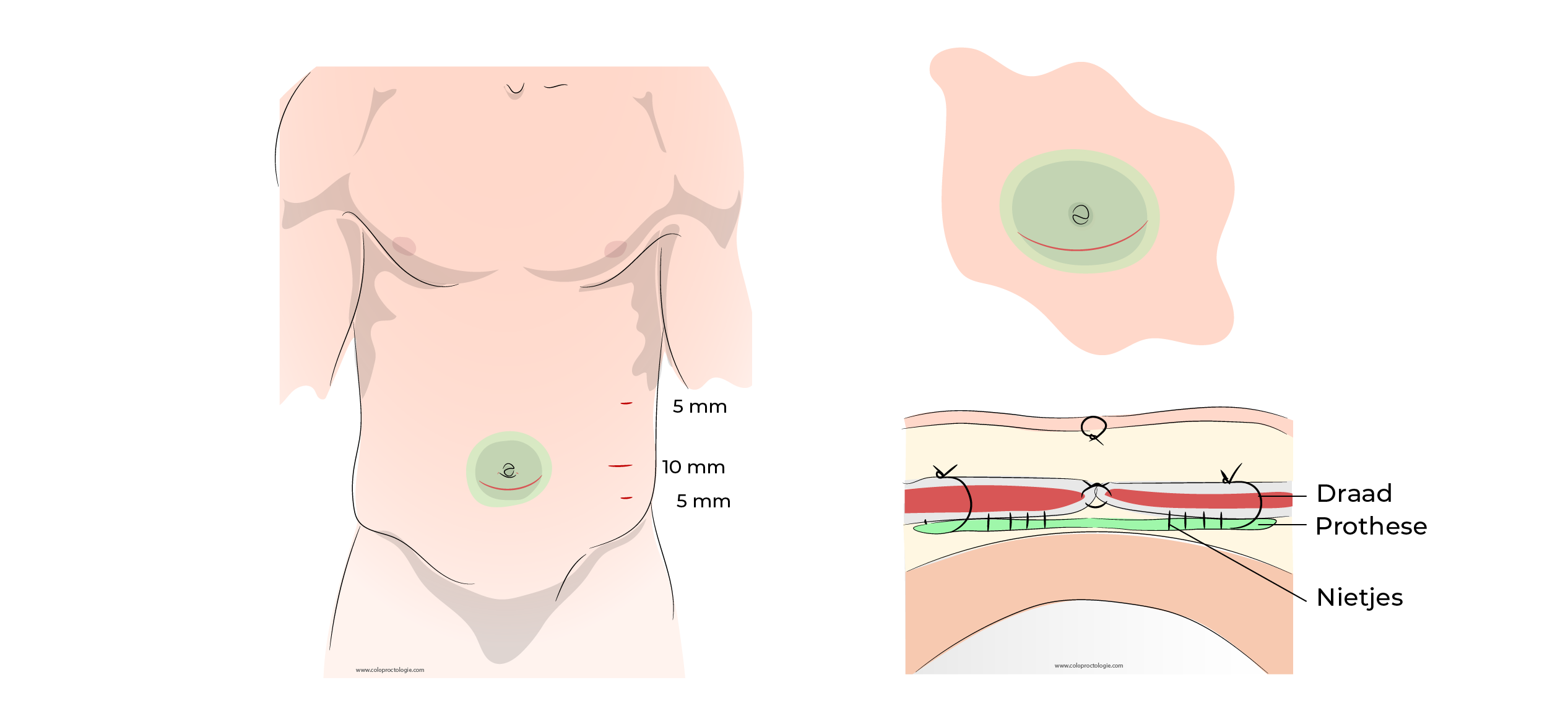 https://coloproctologie.com/wp-content/uploads/2023/07/Hernie-Ombilicale-Illustrations-Dutch-41.webp