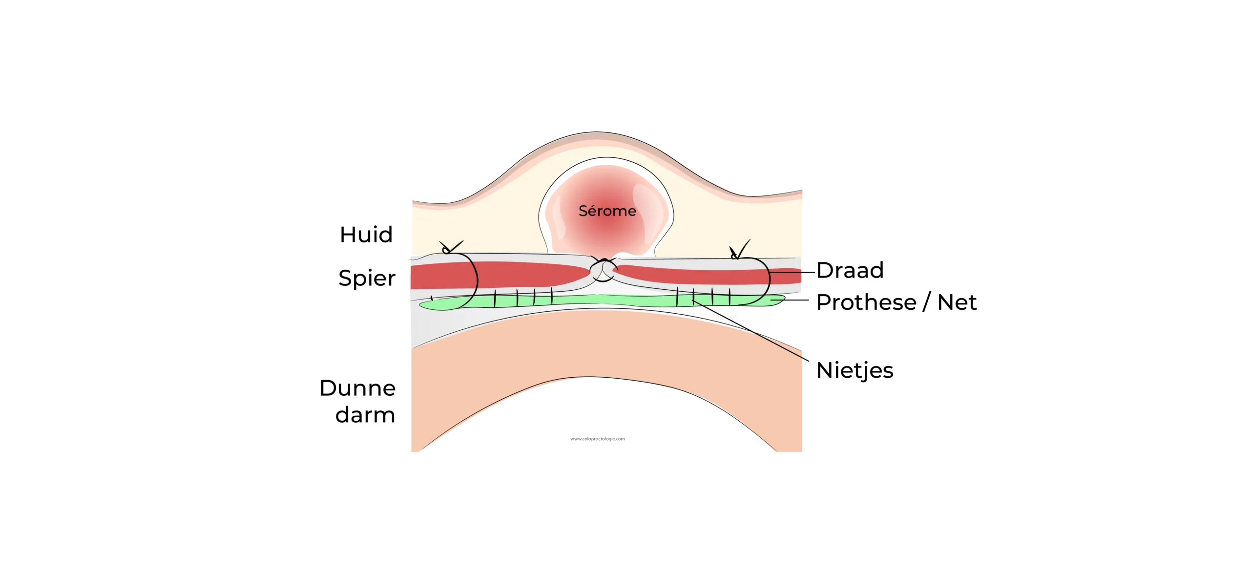 https://coloproctologie.com/wp-content/uploads/2023/07/Hernie-Ombilicale-Serome-Illustrations-31-scaled.webp