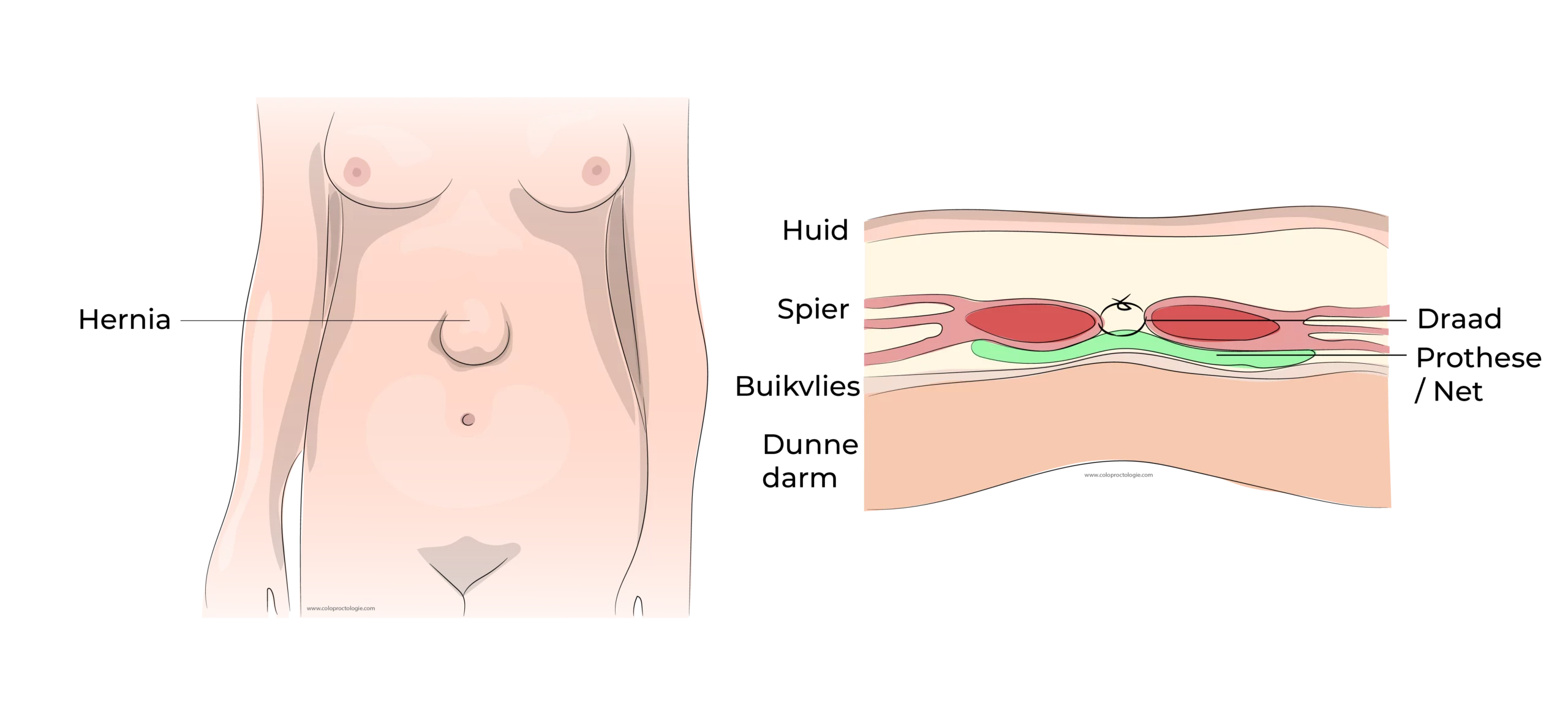 https://coloproctologie.com/wp-content/uploads/2023/07/Hernie-Ombilicale-epigastrique-Illustrations-33-scaled.webp