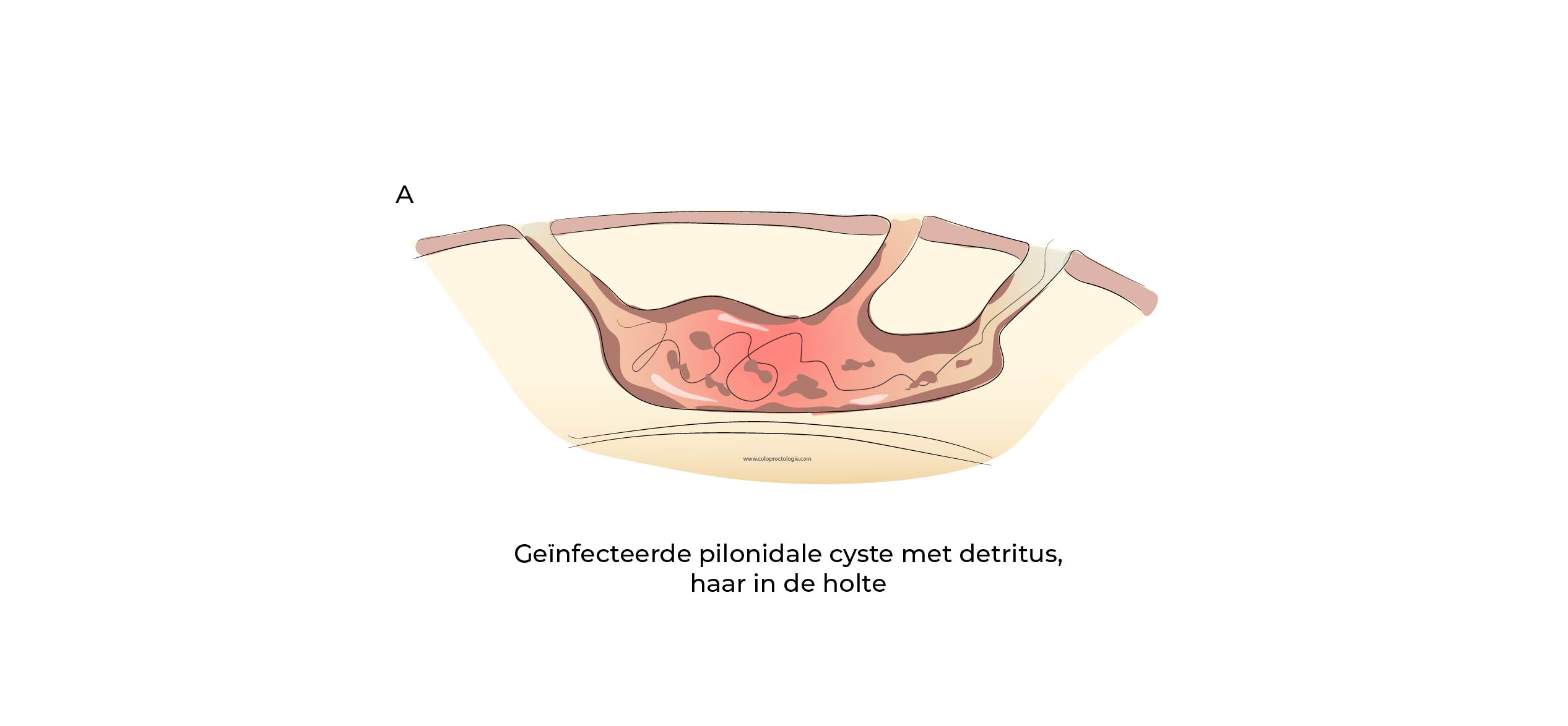 https://coloproctologie.com/wp-content/uploads/2023/07/Kyste-Pilonidale-Illustrations-25.jpg