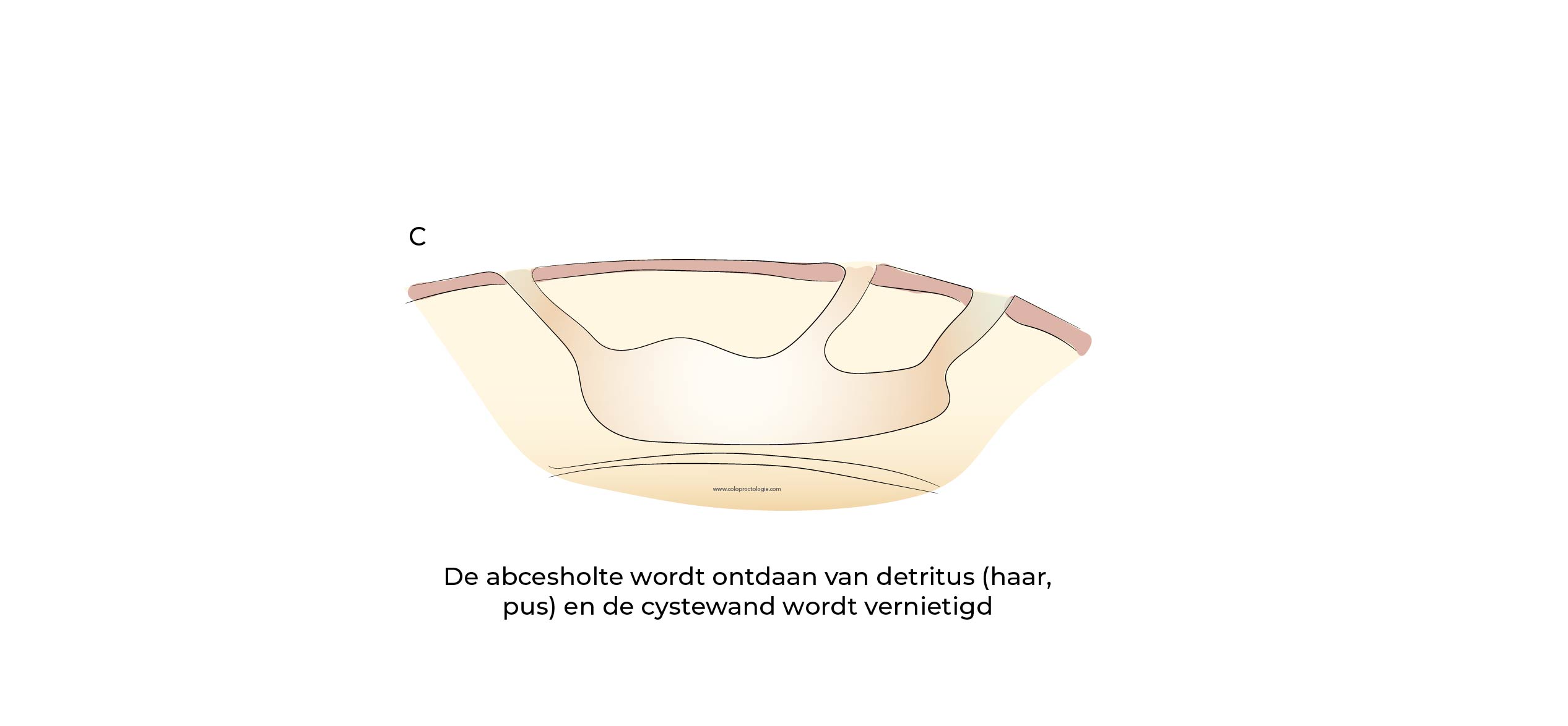 https://coloproctologie.com/wp-content/uploads/2023/07/Kyste-Pilonidale-Illustrations-27.jpg