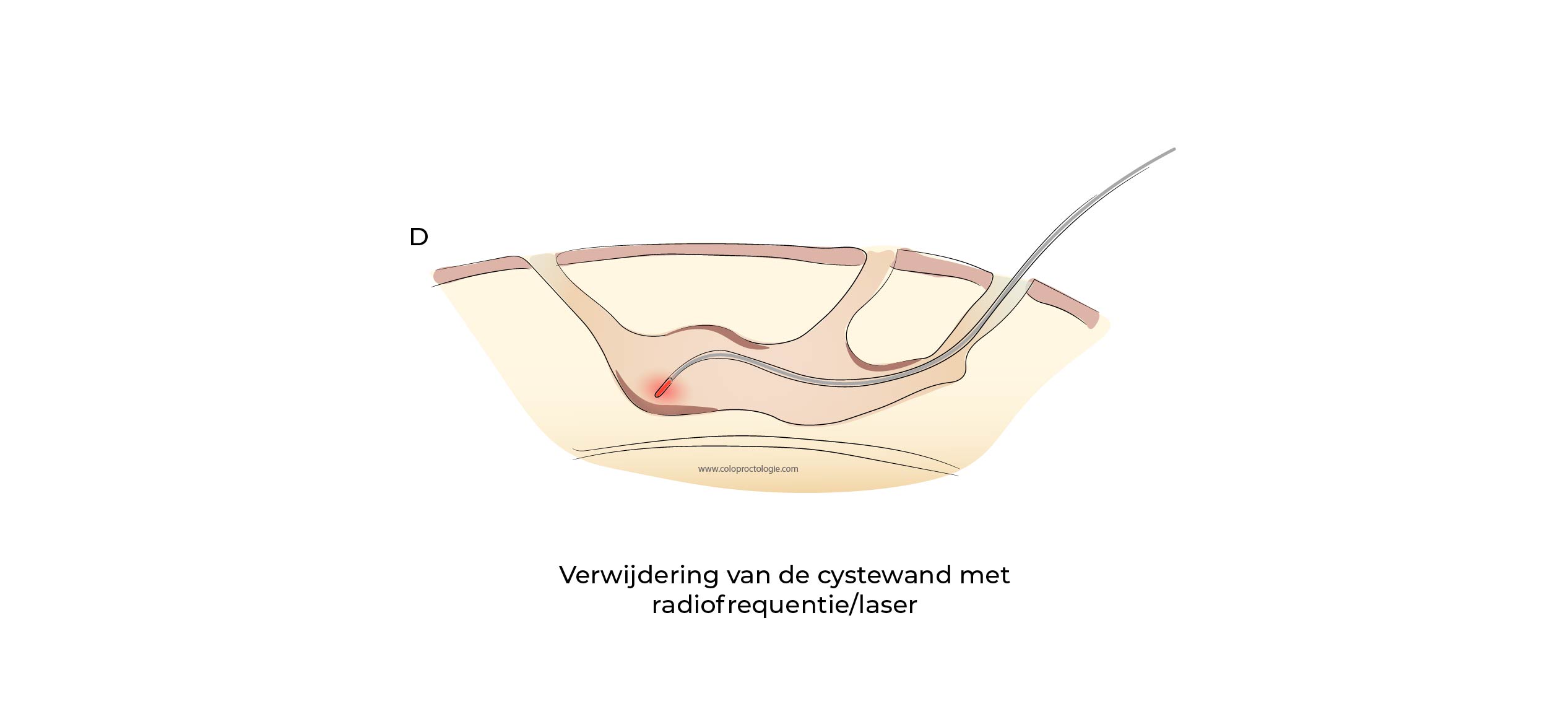 https://coloproctologie.com/wp-content/uploads/2023/07/Kyste-Pilonidale-Illustrations-28.jpg