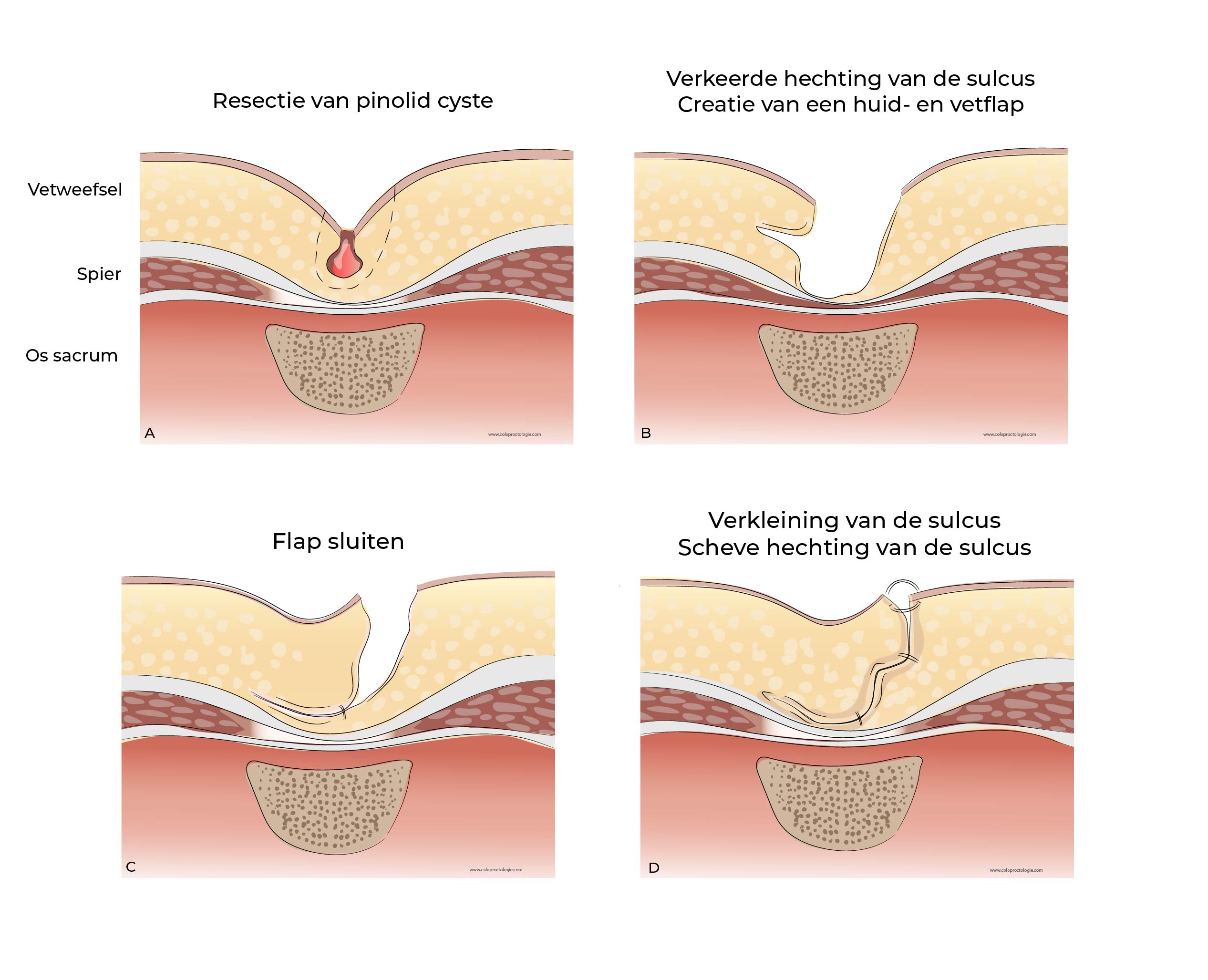 https://coloproctologie.com/wp-content/uploads/2023/07/Kyste-Pilonidale-Illustrations-29.jpg