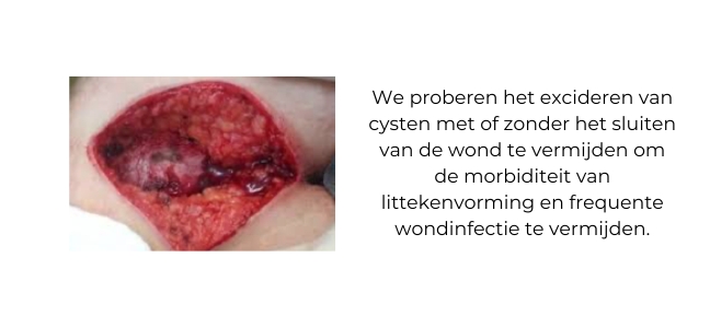 https://coloproctologie.com/wp-content/uploads/2023/07/Kyste-pilonidal-laser-ndls.jpg