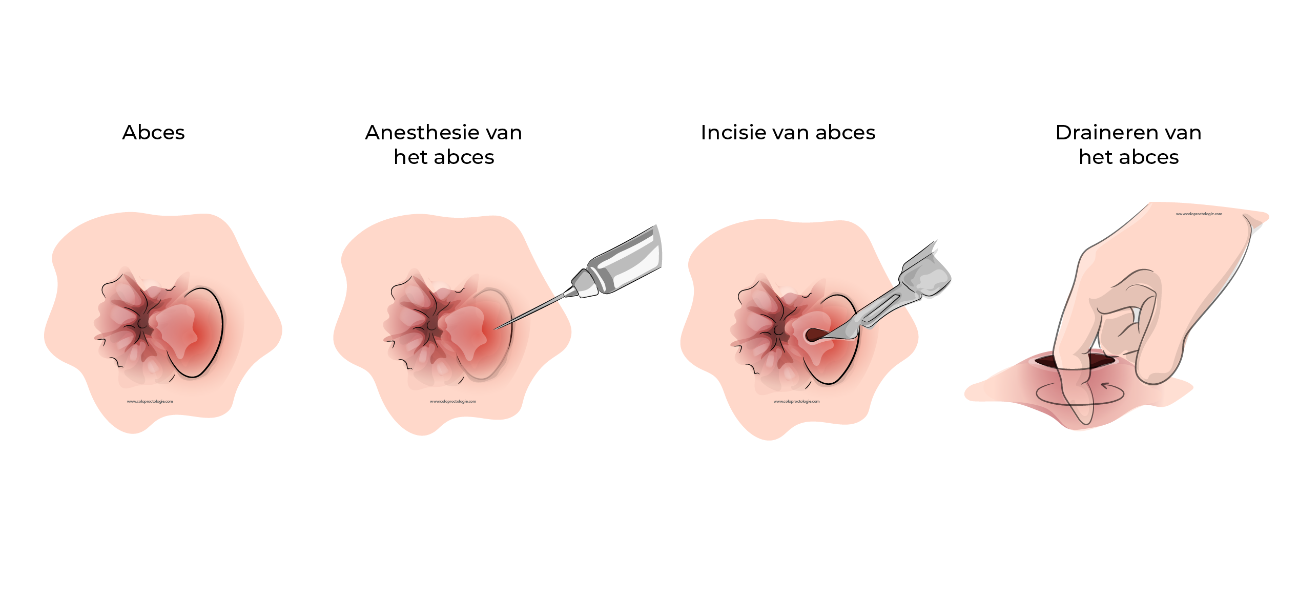 https://coloproctologie.com/wp-content/uploads/2023/09/Abces-anal-26.webp