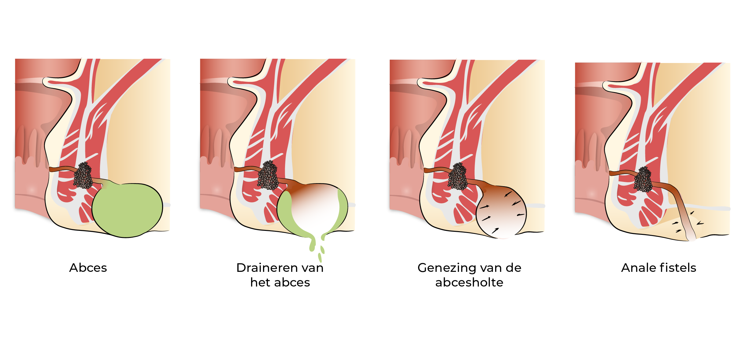 https://coloproctologie.com/wp-content/uploads/2023/09/Abces-anal-27.webp