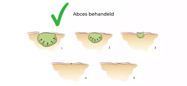 https://coloproctologie.com/wp-content/uploads/2023/09/Abces-traite-ndls-1.webp
