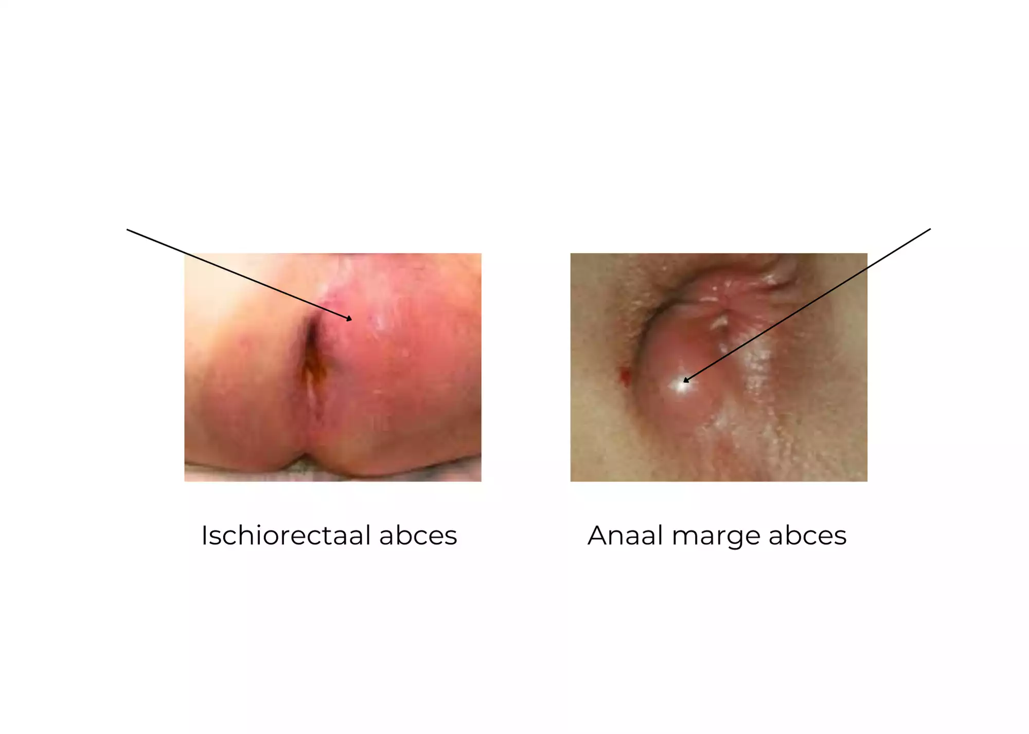 https://coloproctologie.com/wp-content/uploads/2023/09/Anaal-abces-Bomans-Brussel.webp