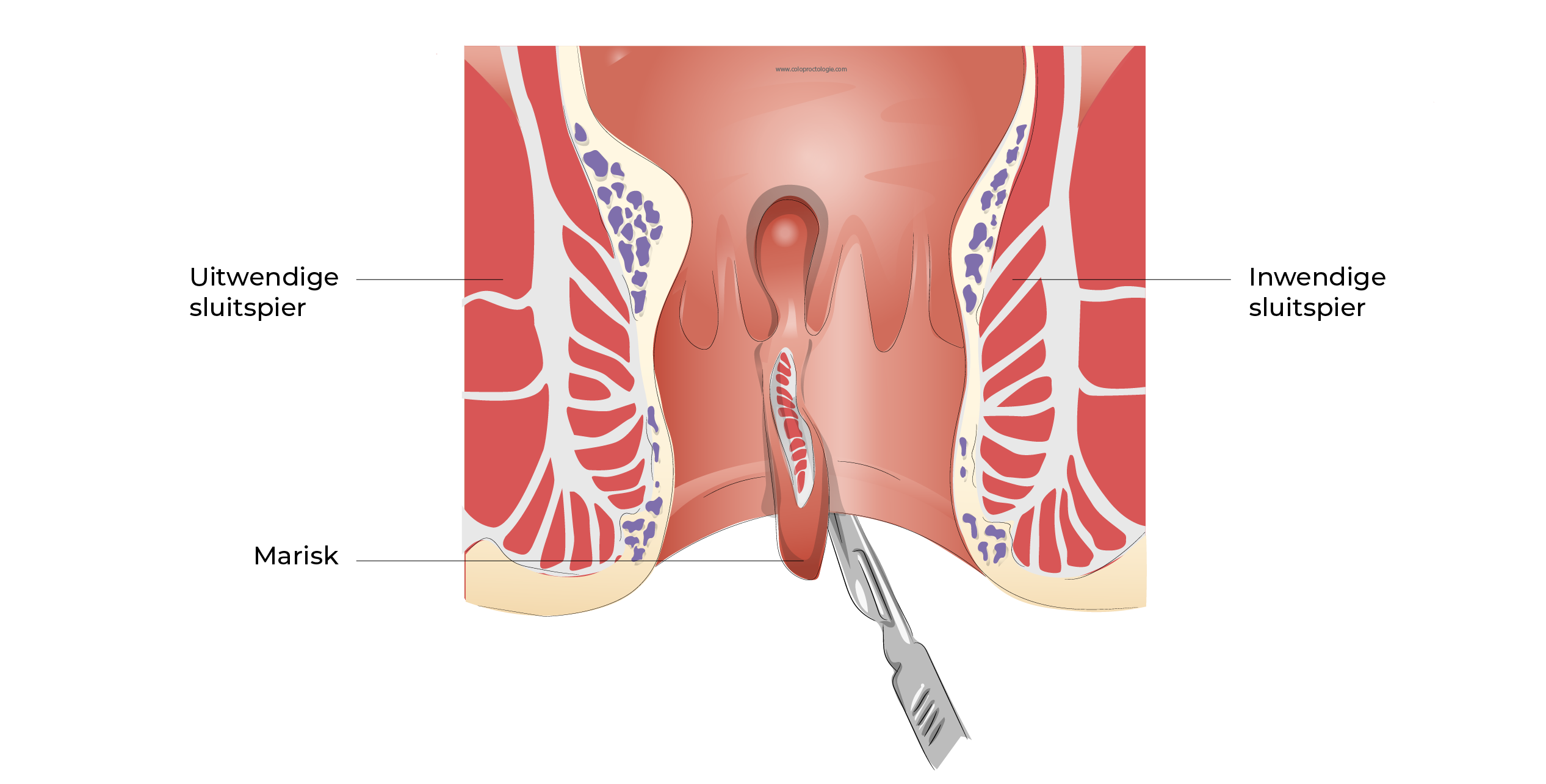 https://coloproctologie.com/wp-content/uploads/2023/09/Fissure-Anale_-23.webp