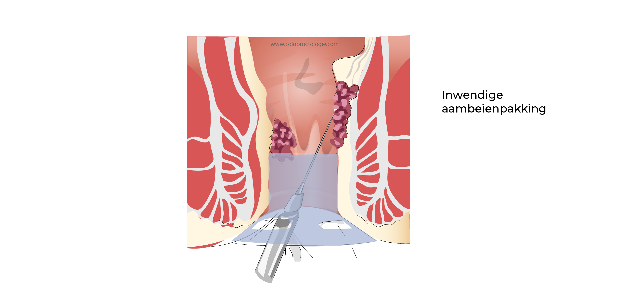 https://coloproctologie.com/wp-content/uploads/2023/09/Hemorroide-44.webp