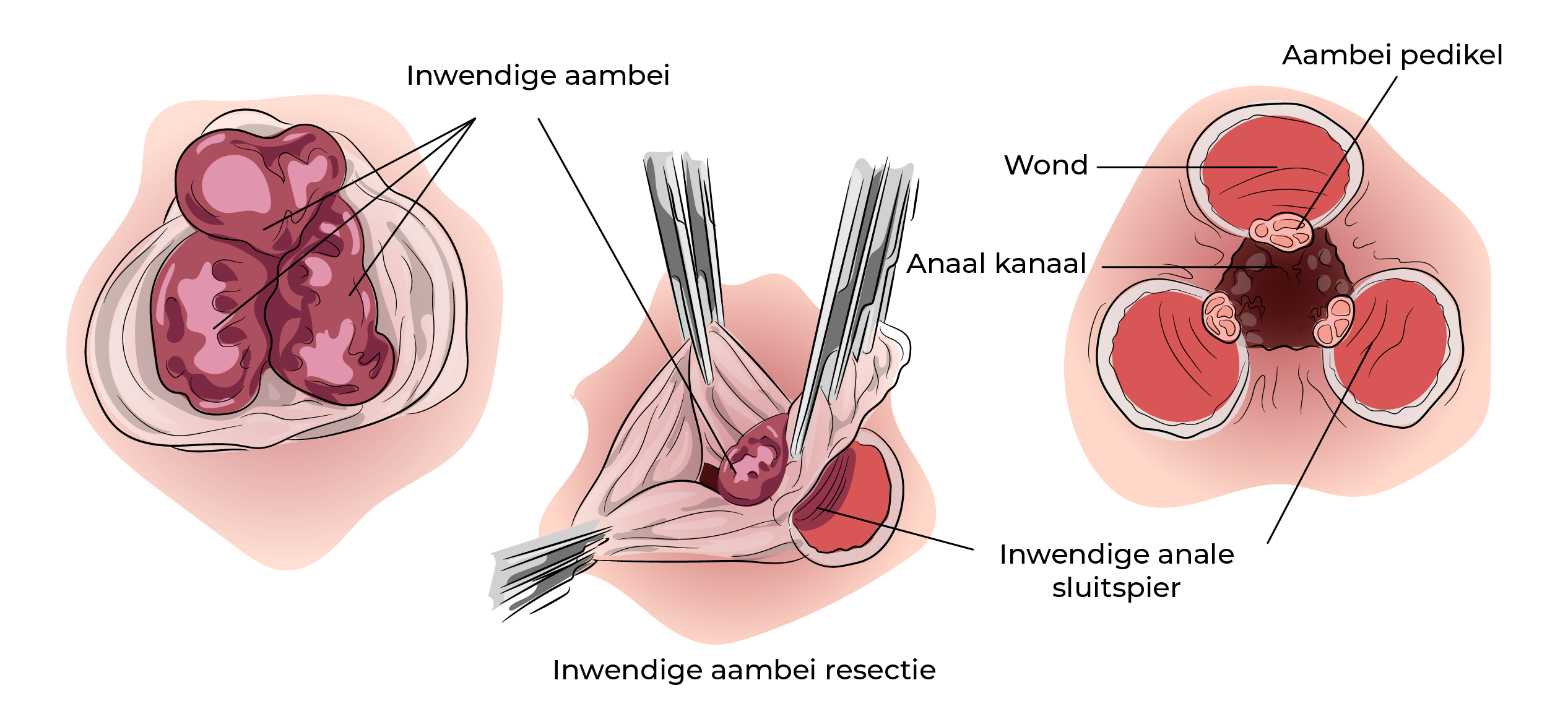 https://coloproctologie.com/wp-content/uploads/2023/09/Hemorroide-50.webp