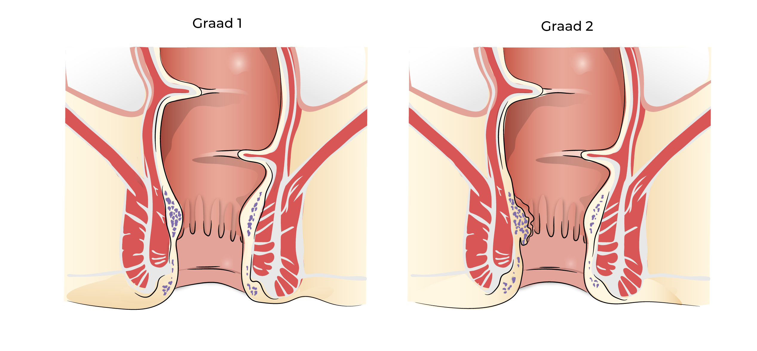 https://coloproctologie.com/wp-content/uploads/2023/09/Hemorroide-sclerotherapie-graad-1-graad-2-19.webp