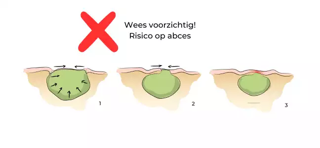 https://coloproctologie.com/wp-content/uploads/2023/09/Risque-abces-ndls-1.webp