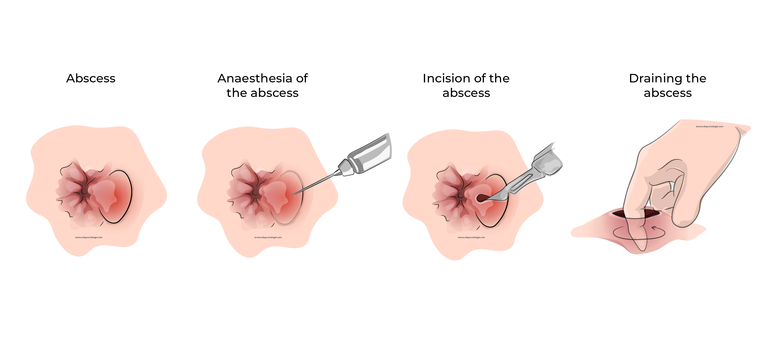 https://coloproctologie.com/wp-content/uploads/2023/10/Abces-anal-28.webp