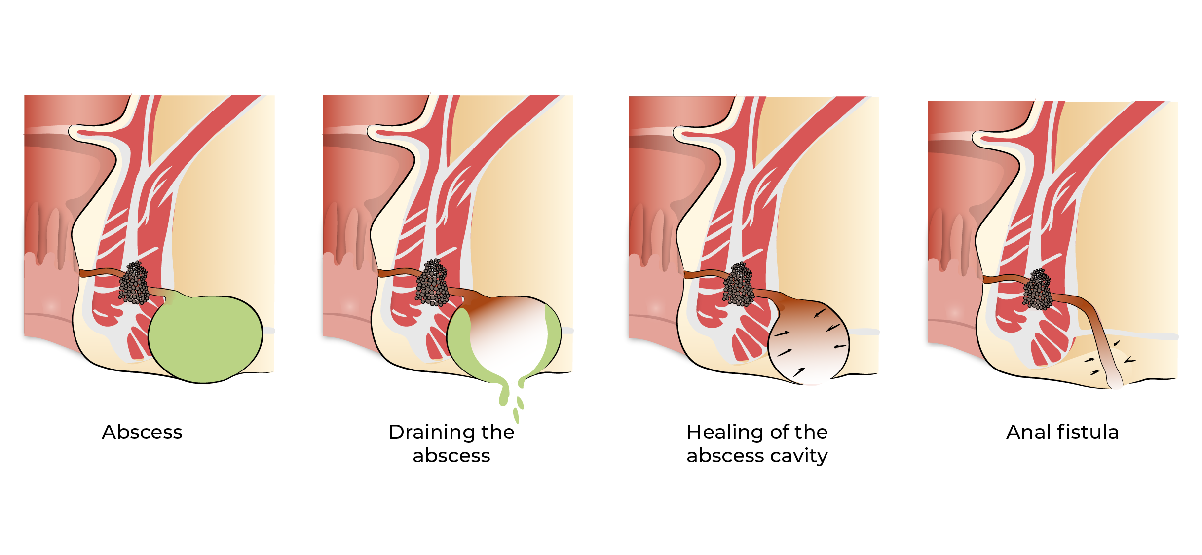 https://coloproctologie.com/wp-content/uploads/2023/10/Abces-anal-29.webp