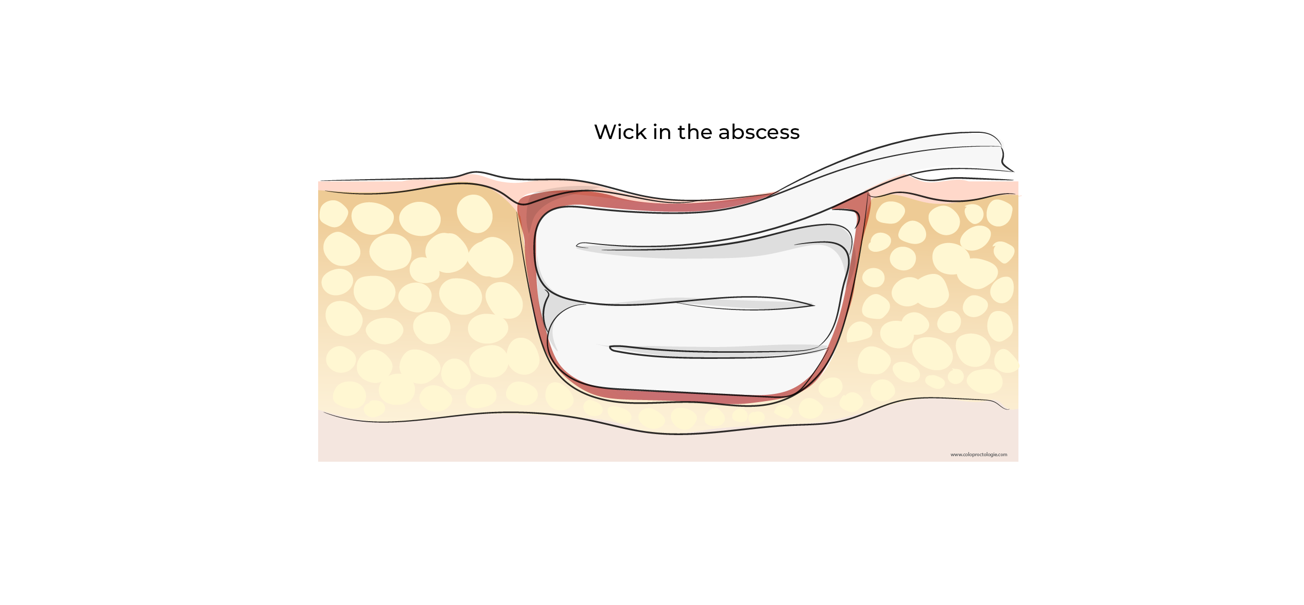 https://coloproctologie.com/wp-content/uploads/2023/10/Abces-anal-31-1.webp