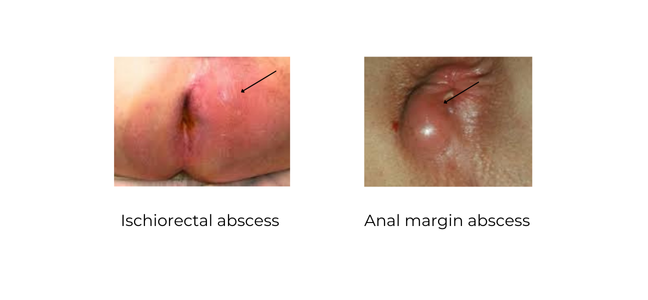 https://coloproctologie.com/wp-content/uploads/2023/10/Abces-anal-English.webp