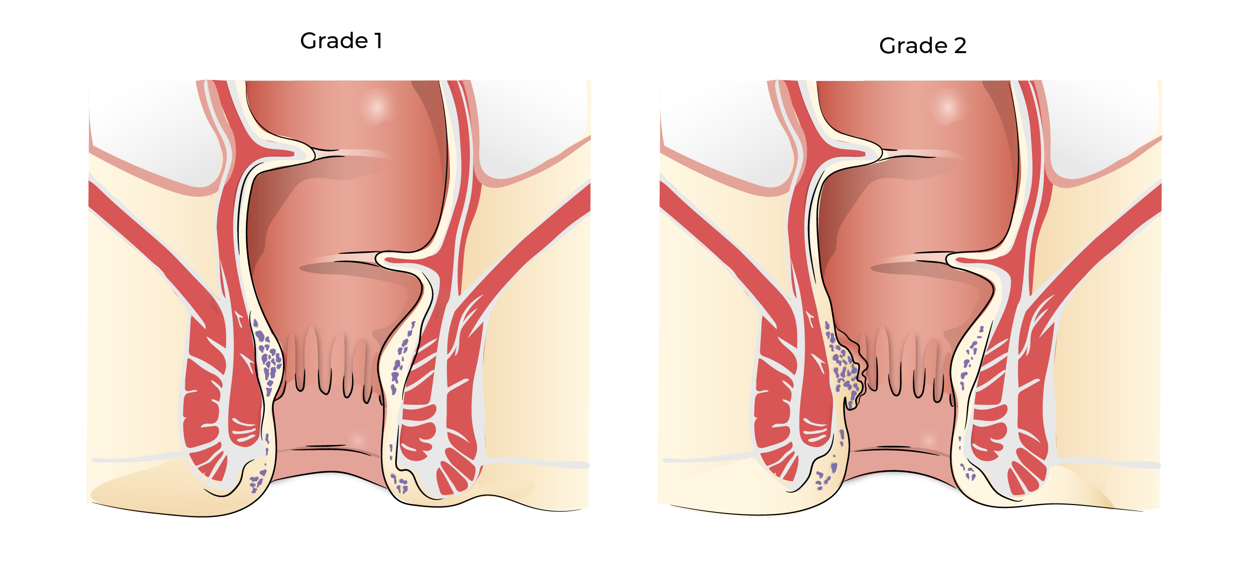 https://coloproctologie.com/wp-content/uploads/2023/10/Hemorroide-Grade-1-Grade-2-bomans-18.webp