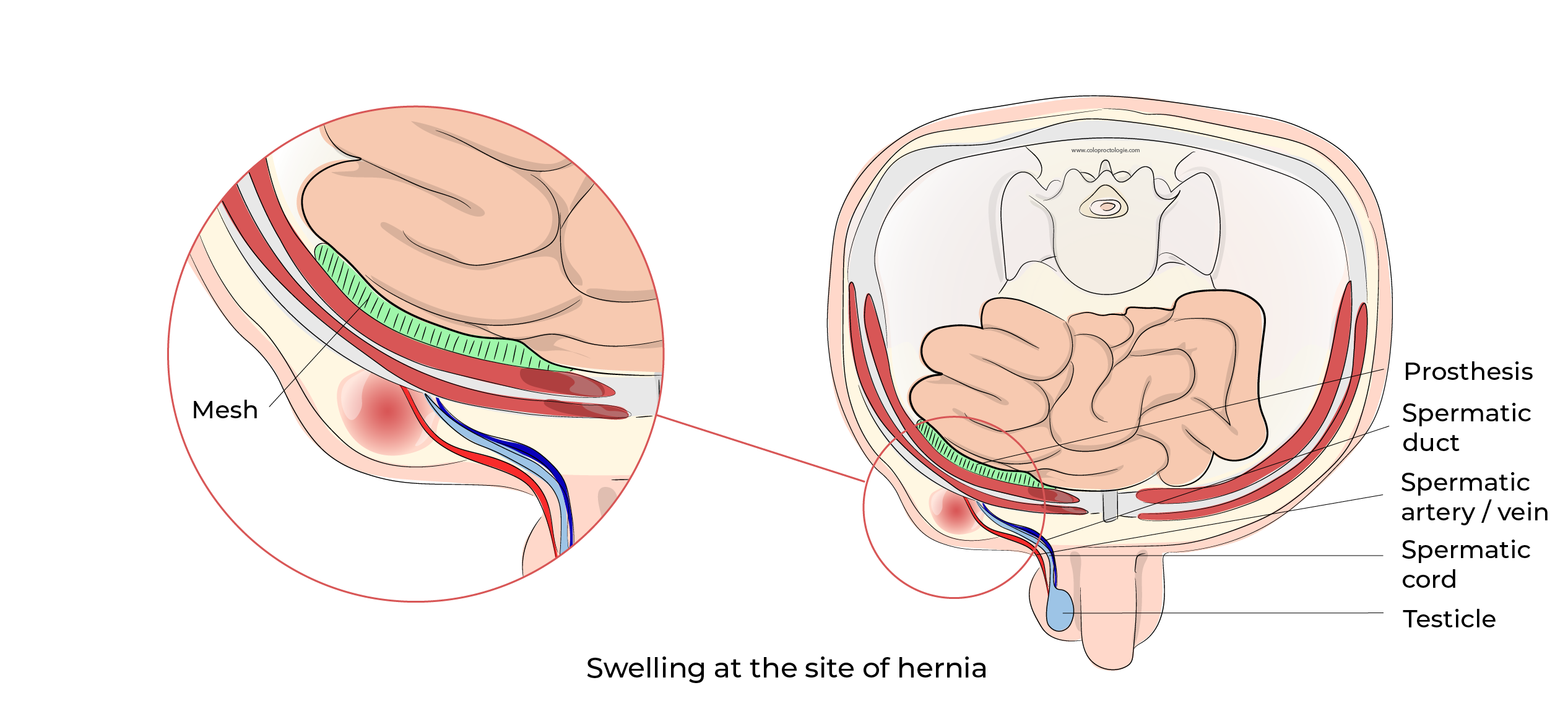 https://coloproctologie.com/wp-content/uploads/2023/10/Hernie-Inguinales-Illustrations-English-31.webp