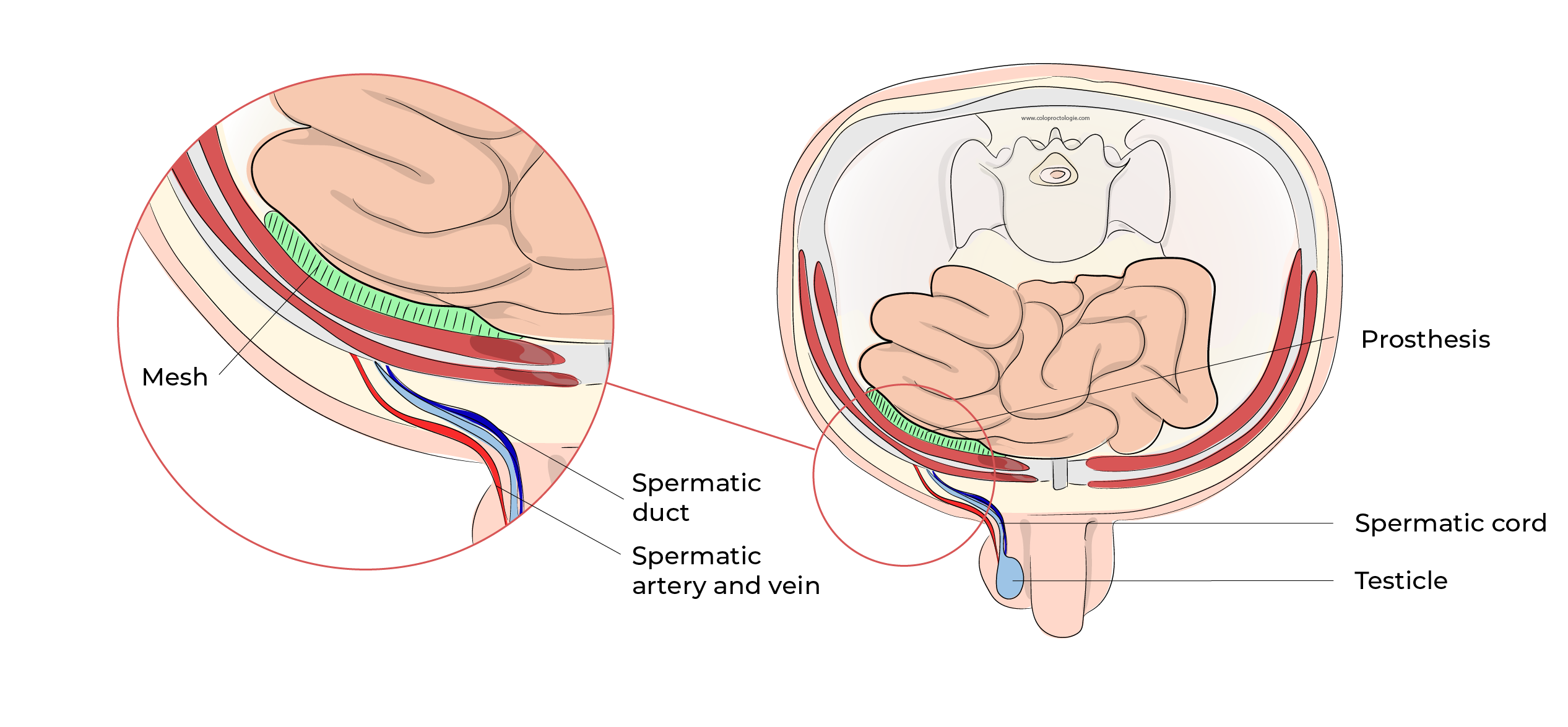 https://coloproctologie.com/wp-content/uploads/2023/10/Hernie-Inguinales-Illustrations-English-32.webp