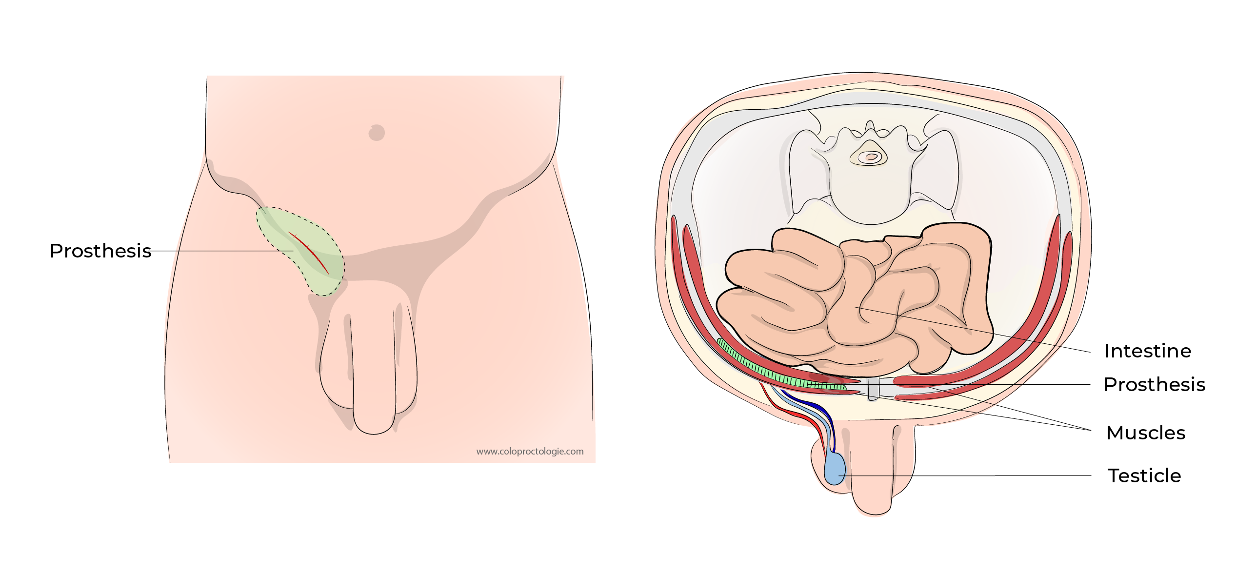 https://coloproctologie.com/wp-content/uploads/2023/10/Hernie-Inguinales-Illustrations-English-33.webp