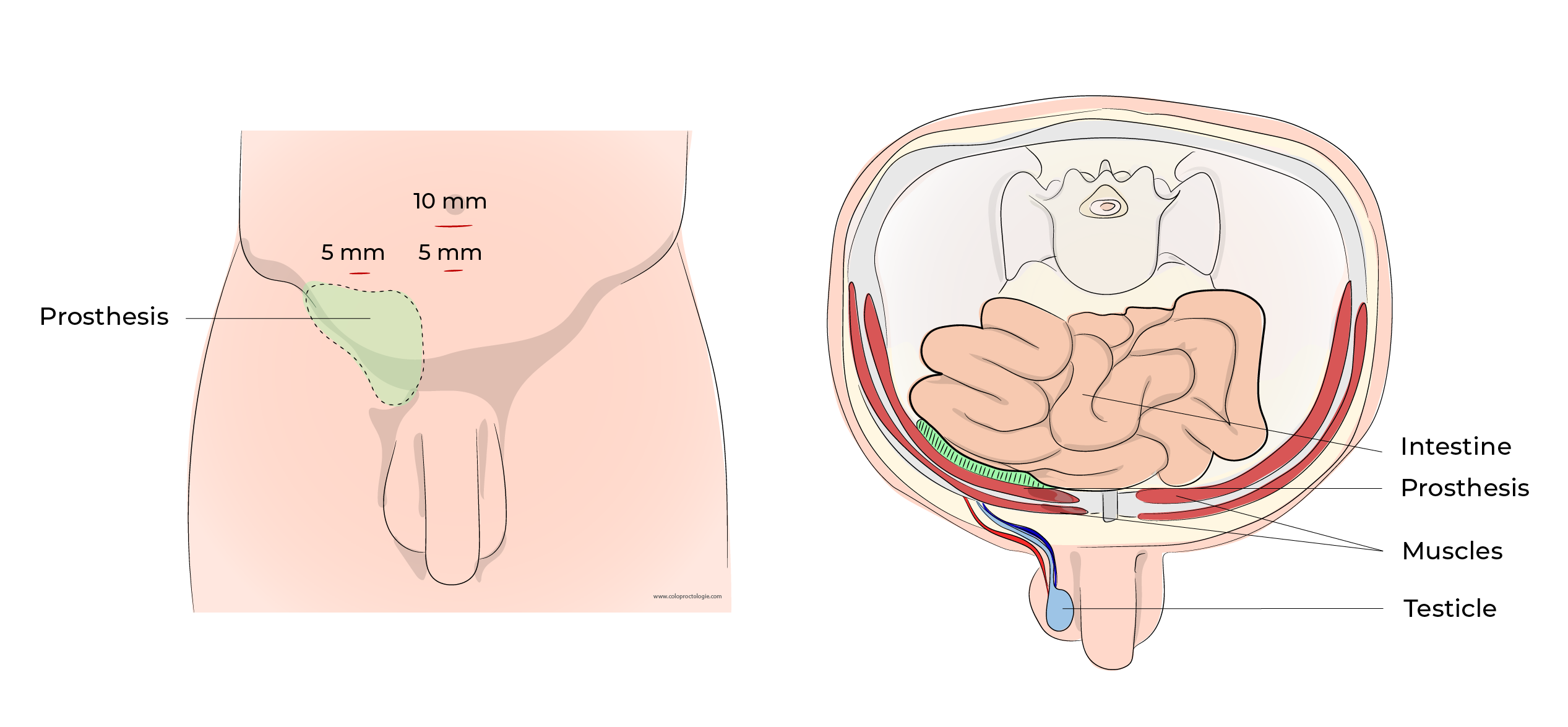 https://coloproctologie.com/wp-content/uploads/2023/10/Hernie-Inguinales-Illustrations-English-34.webp