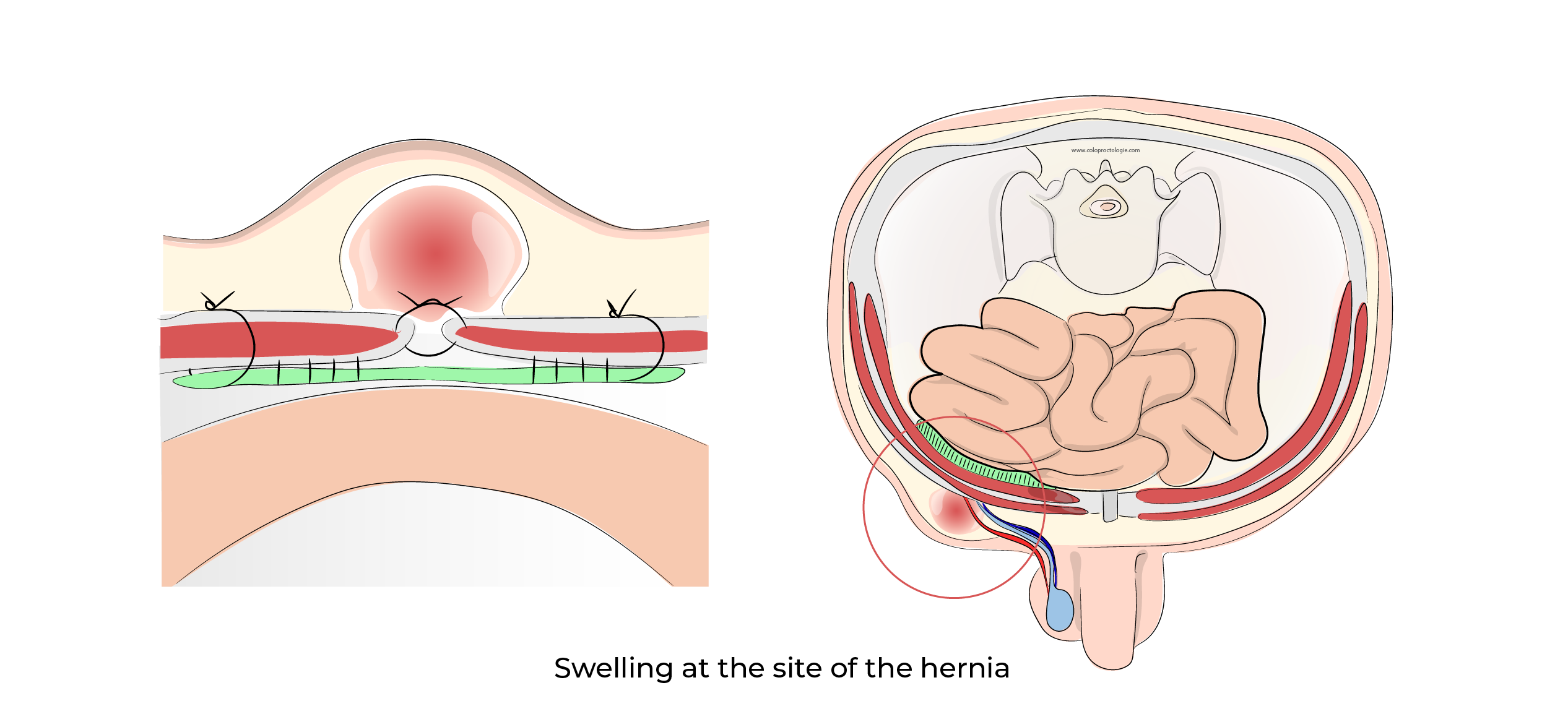 https://coloproctologie.com/wp-content/uploads/2023/10/Hernie-Inguinales-Illustrations-English-35.webp