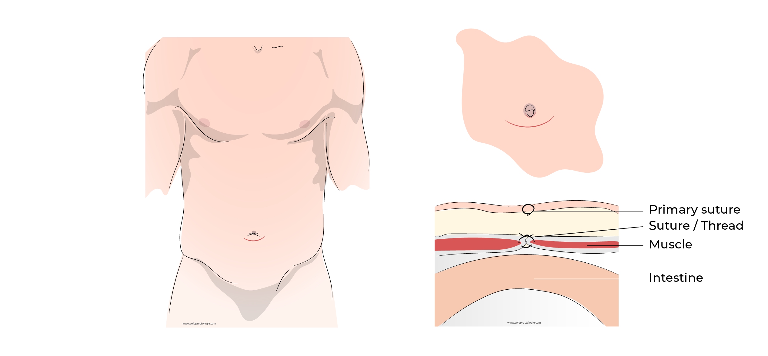 https://coloproctologie.com/wp-content/uploads/2023/10/Hernie-Ombilicale-Illustrations-English-37.webp