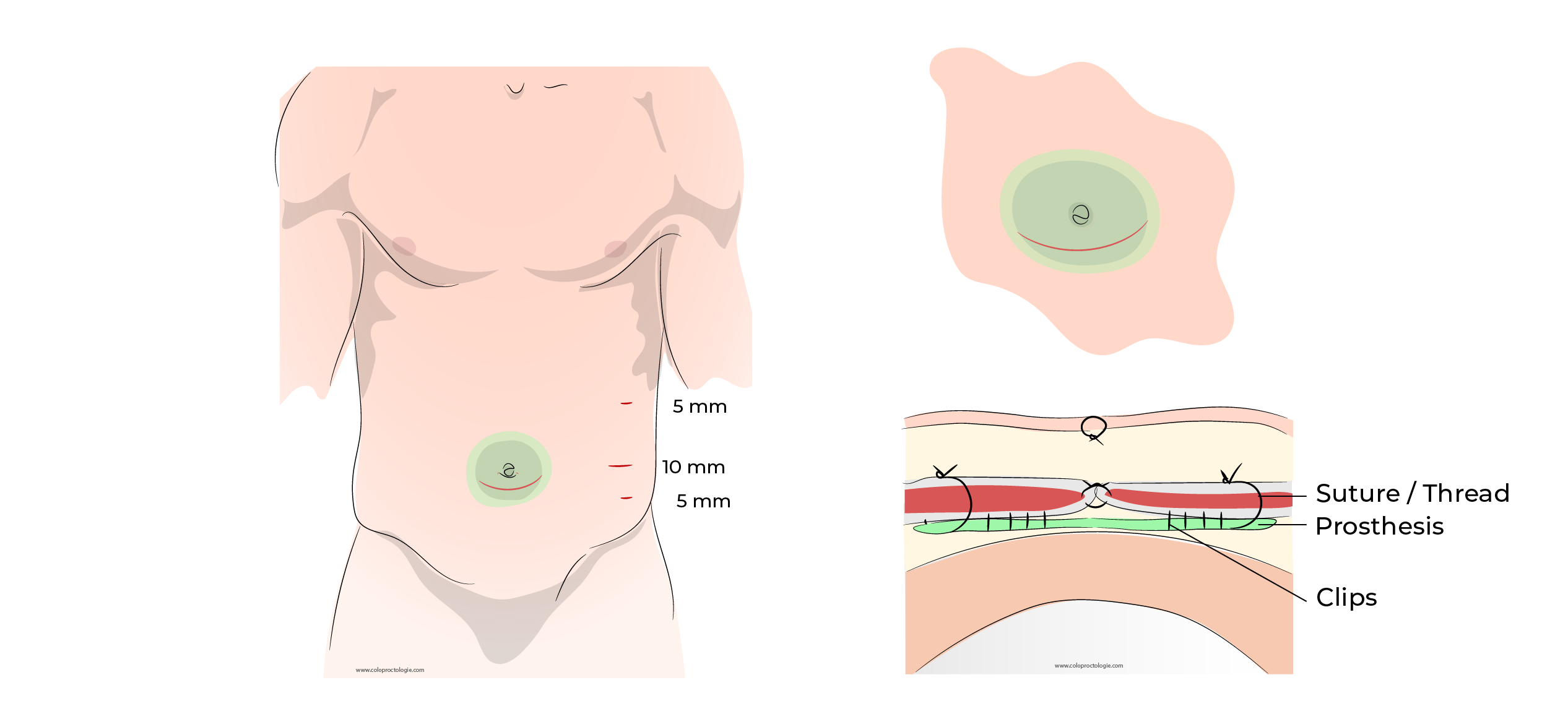 https://coloproctologie.com/wp-content/uploads/2023/10/Hernie-Ombilicale-Illustrations-English-38.webp