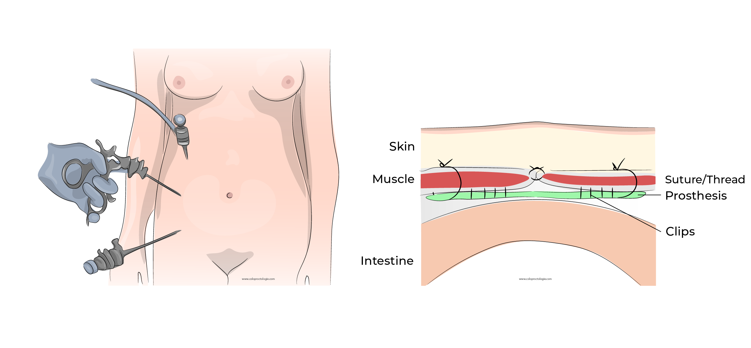 https://coloproctologie.com/wp-content/uploads/2023/10/Hernie-Ombilicale-Illustrations-English-39.webp