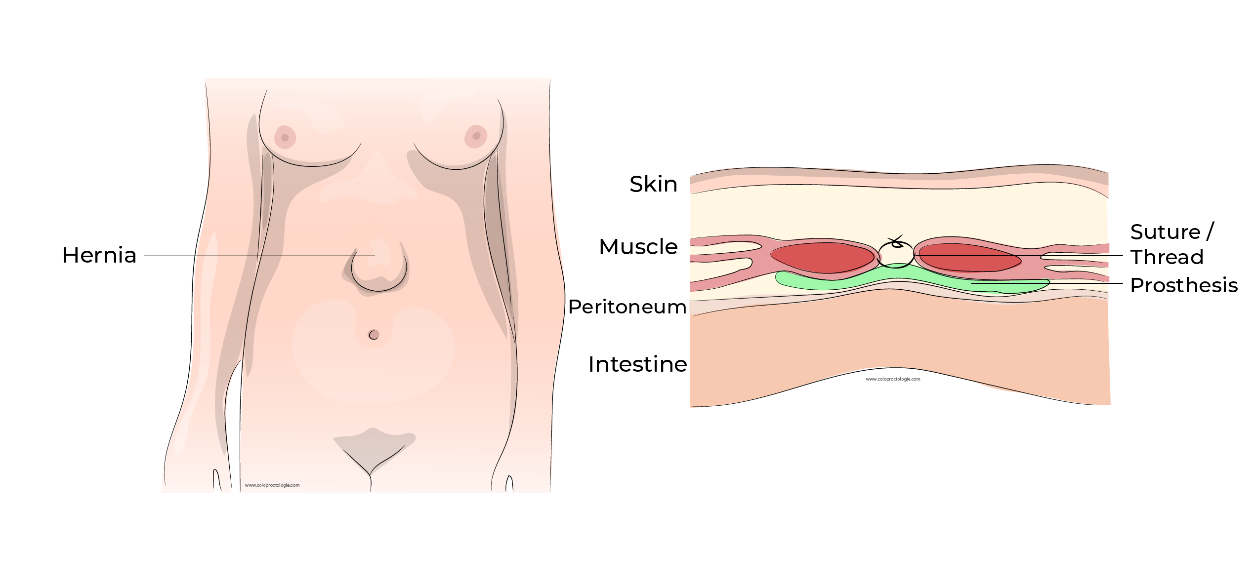 https://coloproctologie.com/wp-content/uploads/2023/10/Hernie-Ombilicale-Illustrations-English-40.webp