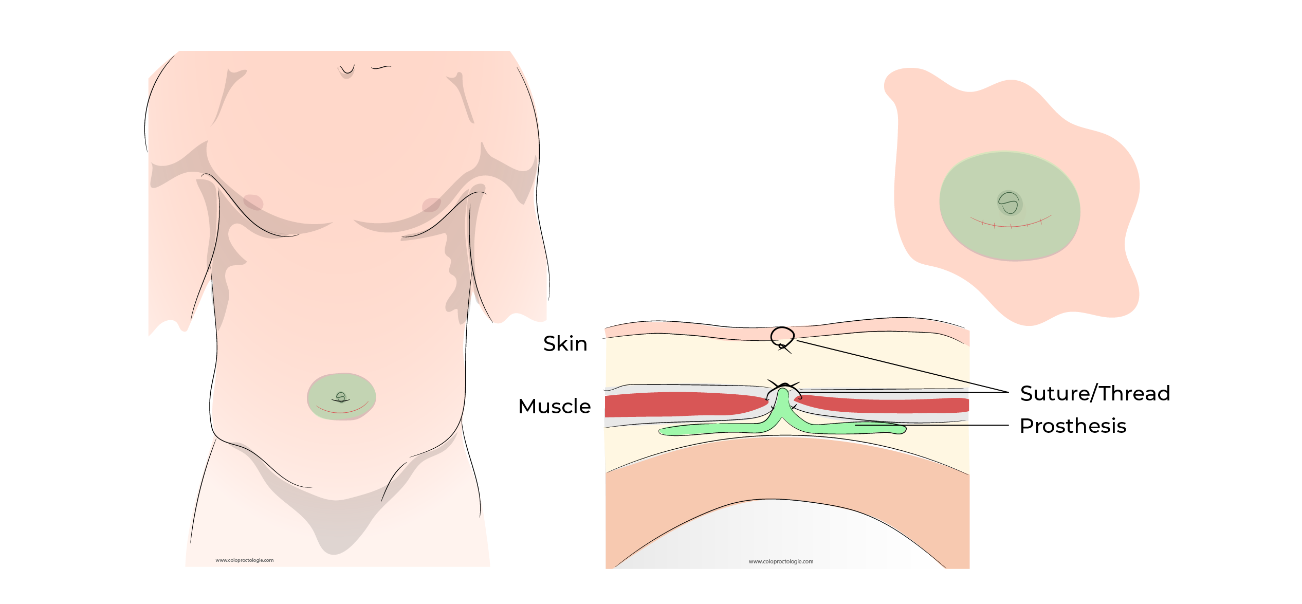 https://coloproctologie.com/wp-content/uploads/2023/10/Hernie-Ombilicale-Illustrations-English-41.webp