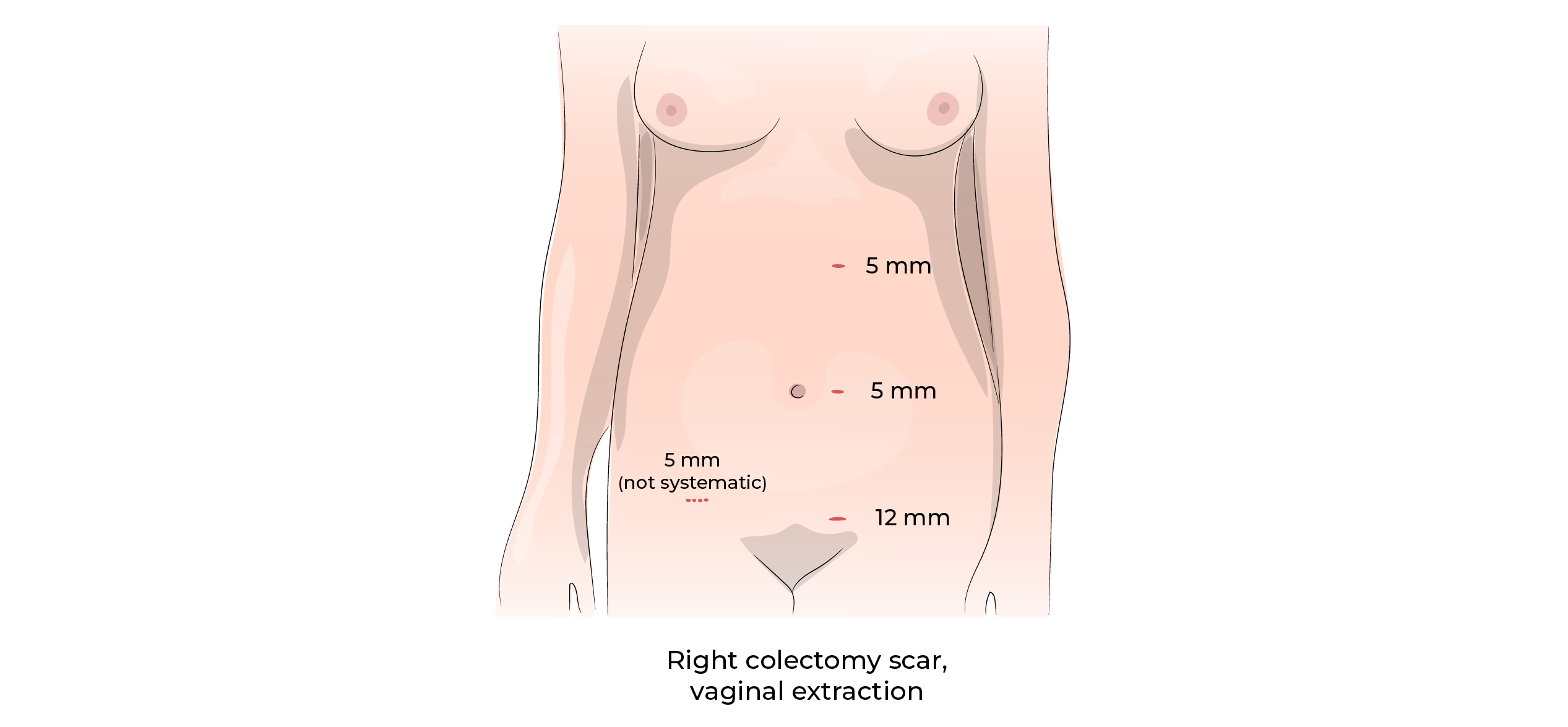 https://coloproctologie.com/wp-content/uploads/2023/10/Left-colectomy-08.webp