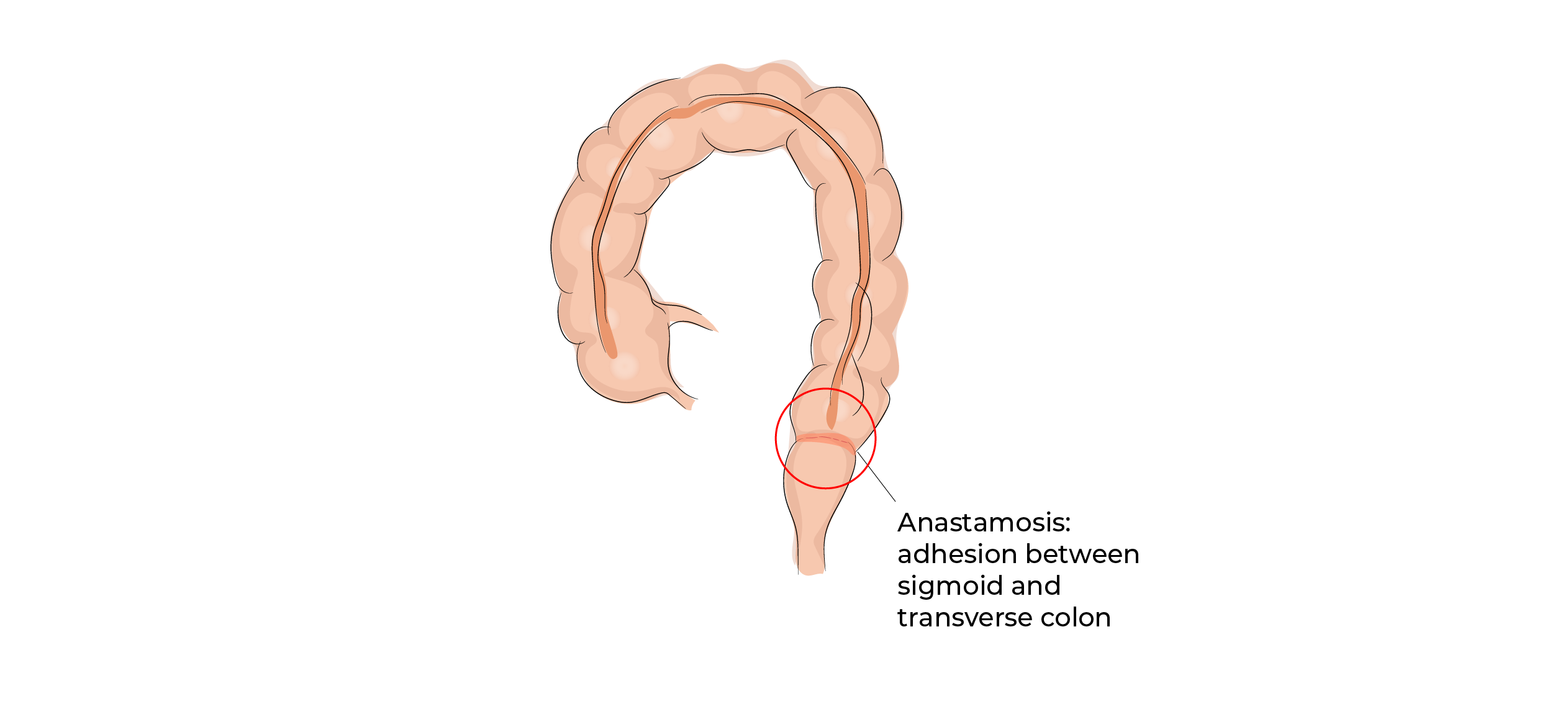 https://coloproctologie.com/wp-content/uploads/2023/10/Left-colectomy-09.webp