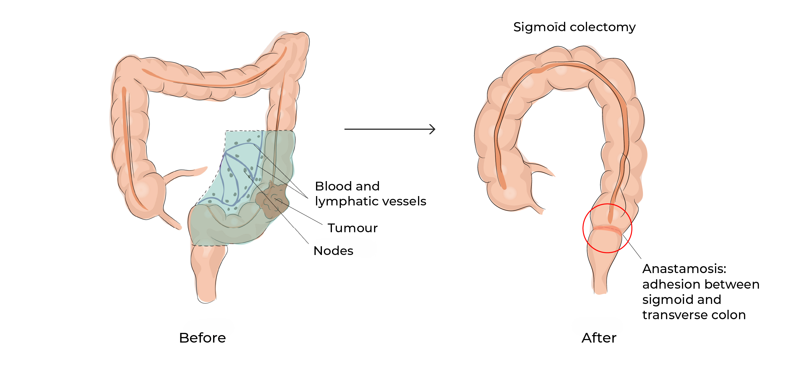 https://coloproctologie.com/wp-content/uploads/2023/10/Left-colectomy-12.webp